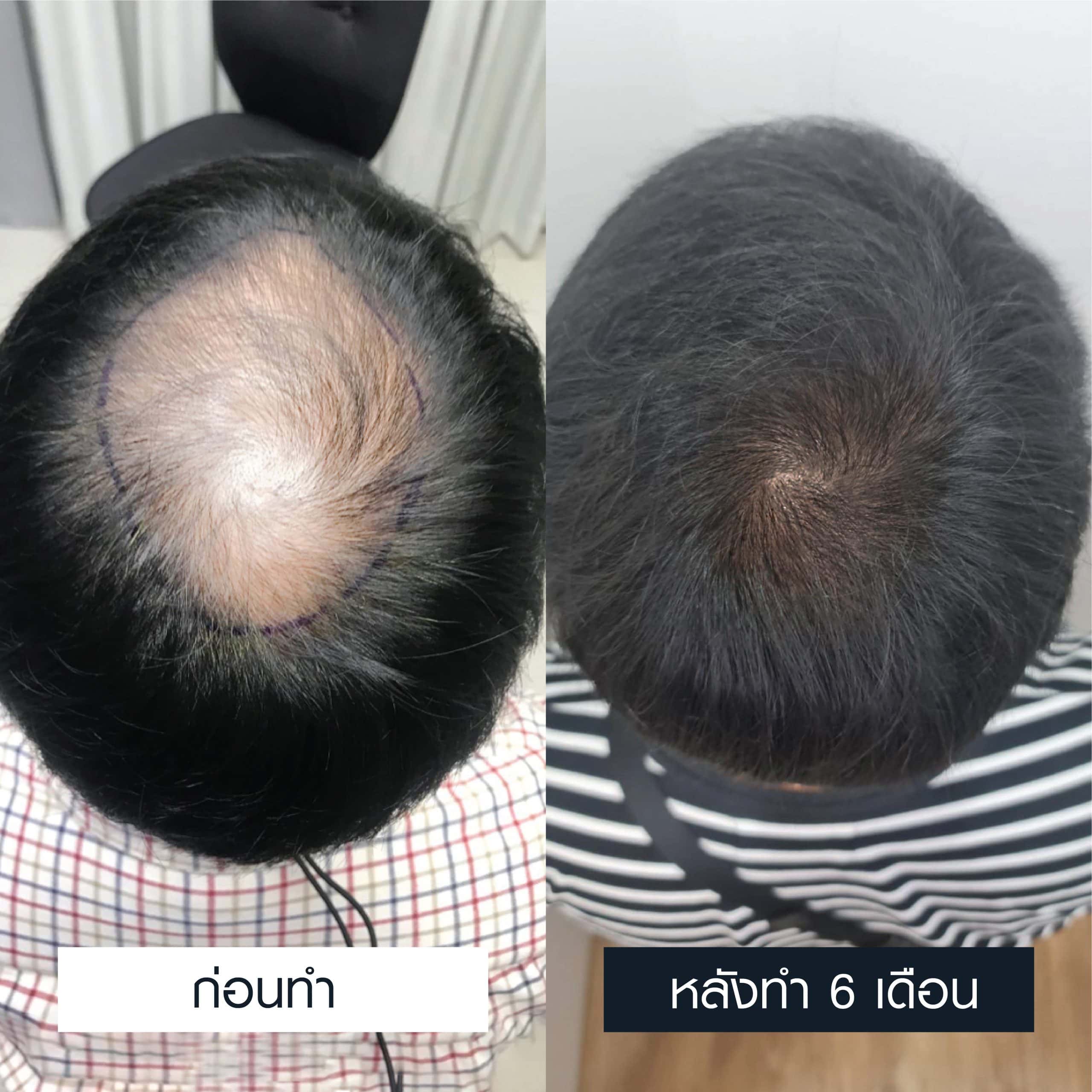 รีวิวการรักษาผมบาง ก่อนและหลังทำ 4 เดือน