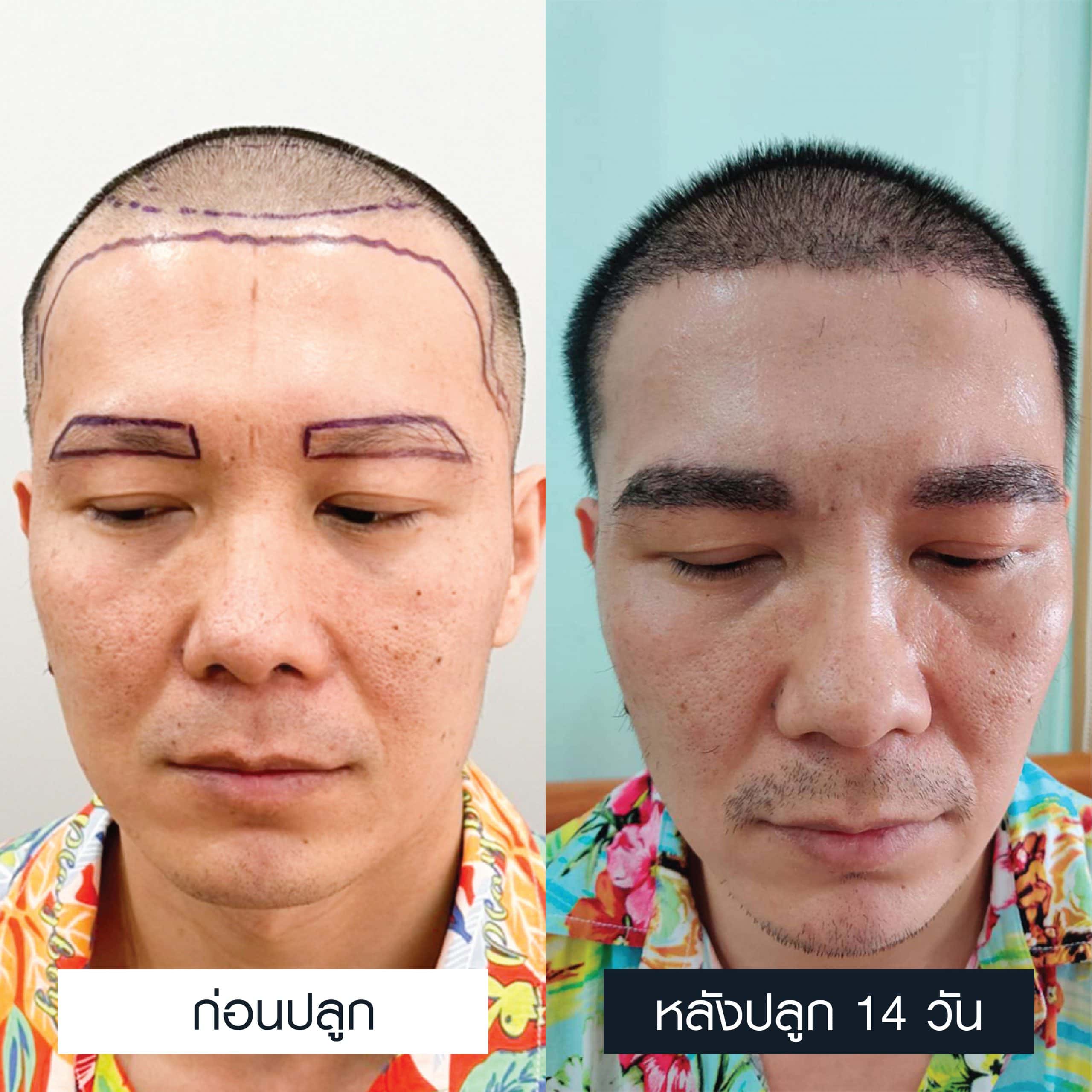 รีวิวปลูกคิ้ว 800 กราฟ ก่อนและหลังปลูก 14 วัน