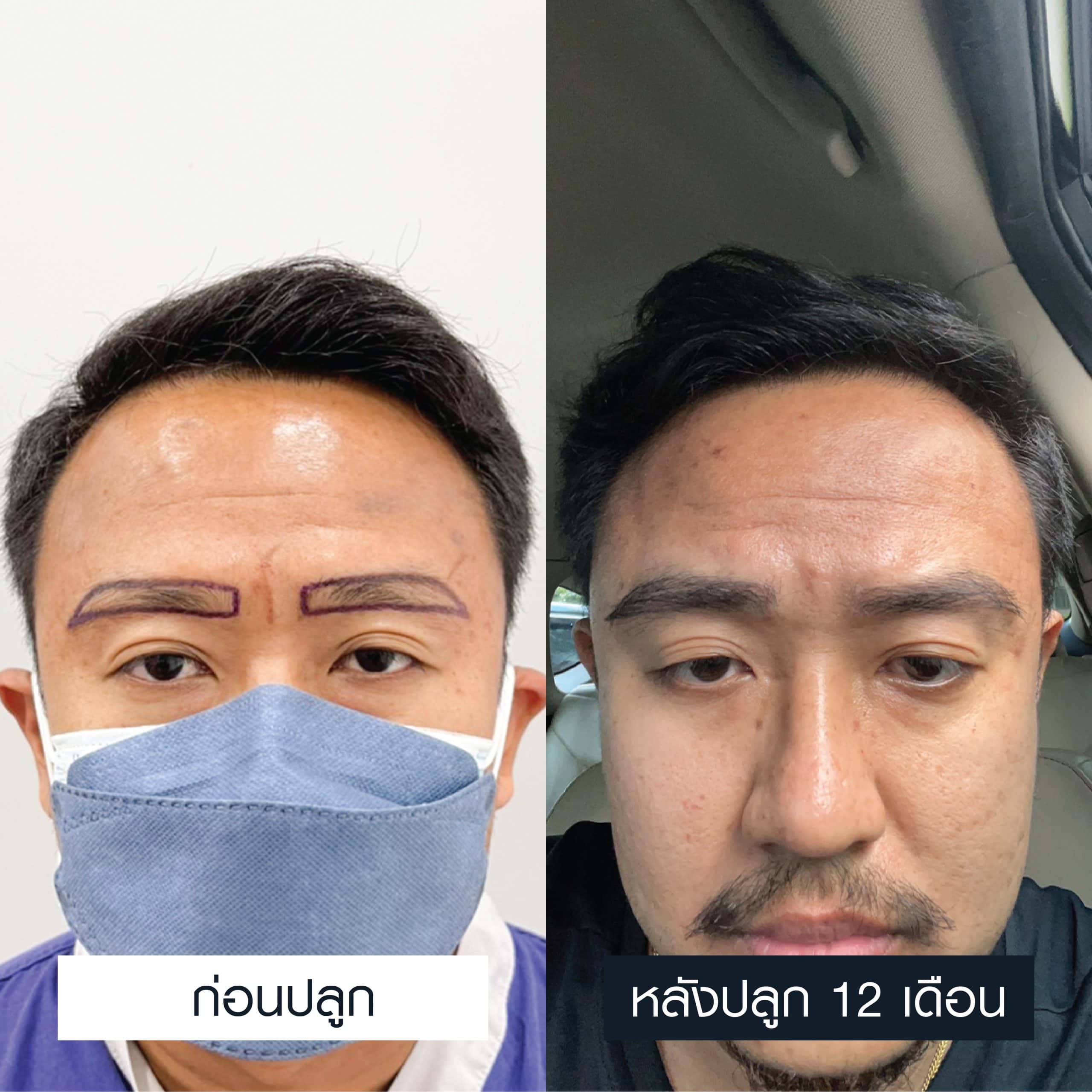ภาพเปรียบเทียบผู้ชายก่อนและหลังปลูกคิ้ว 750 กราฟต์ ครบ 12 เดือน
