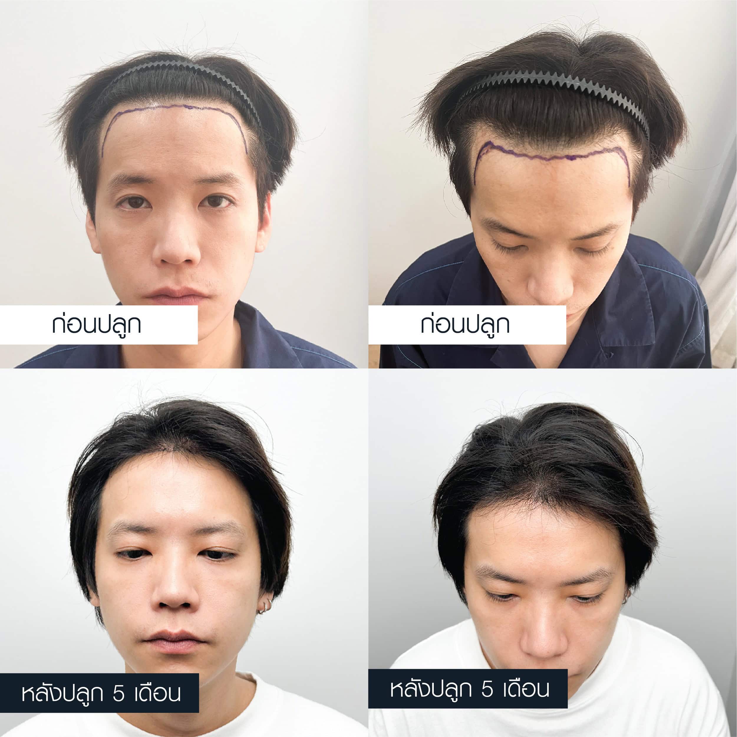 ภาพเปรียบเทียบก่อนและหลังปลูกผม 5 เดือน มุมตรงและมุมก้มของ คชา นนทนันท์ อัญชุลีประดิษฐ์