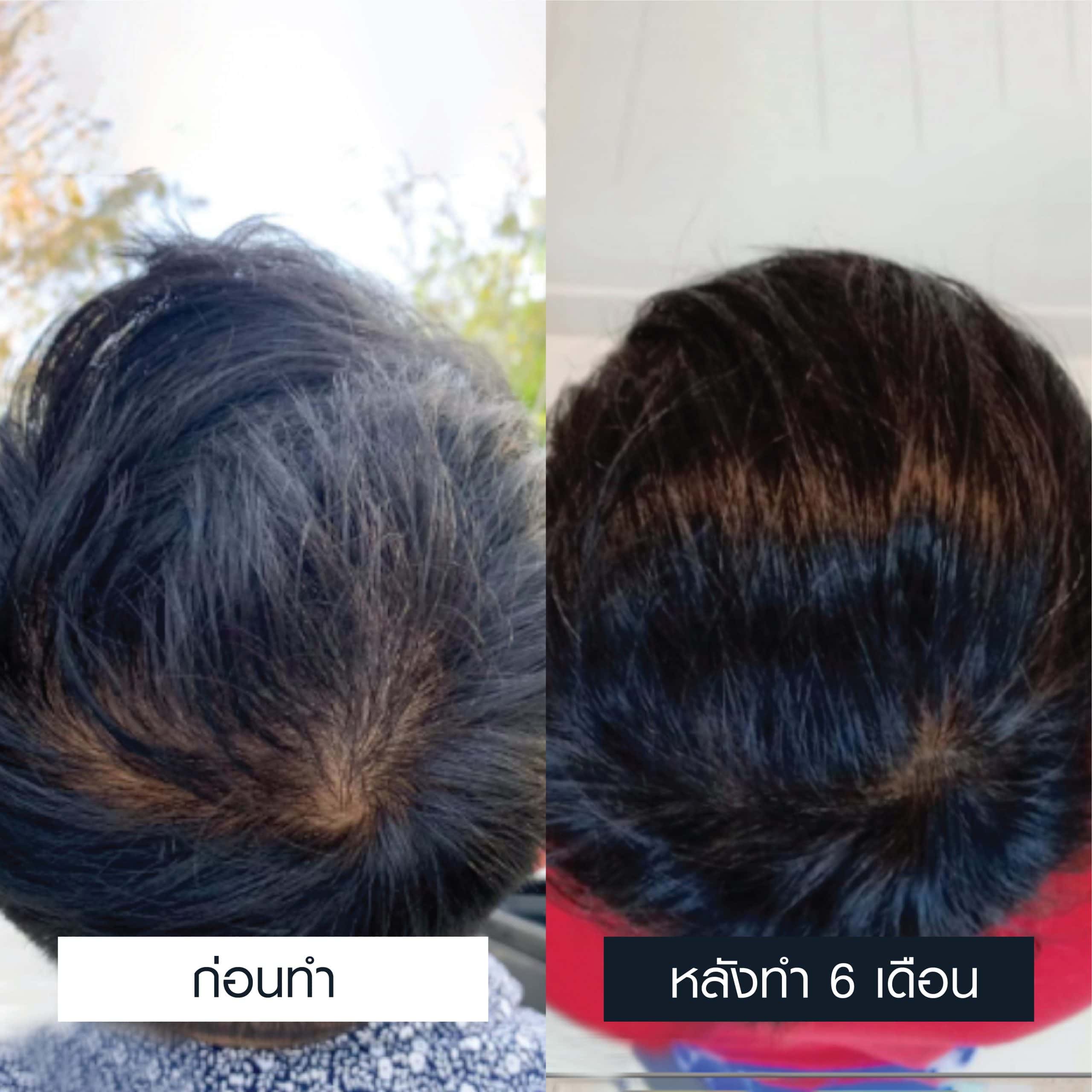 เปรียบเทียบผลลัพธ์การปลูกผมโดยใช้เกล็ดเลือดเข้มข้นหลังผ่านไป 6 เดือน