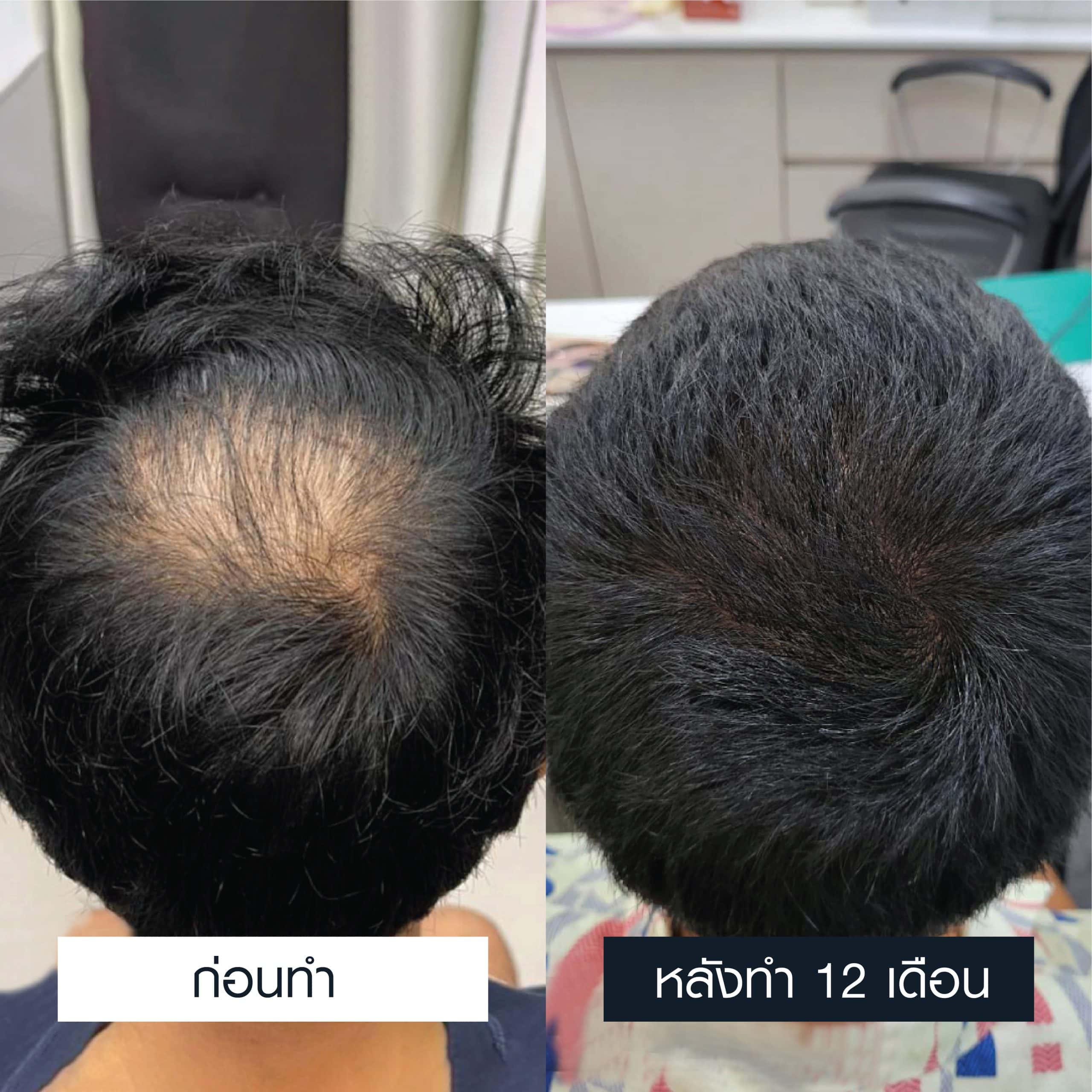 เคสรีวิวเปรียบเทียบก่อนและหลังการรักษาผมบางที่ Max Hair