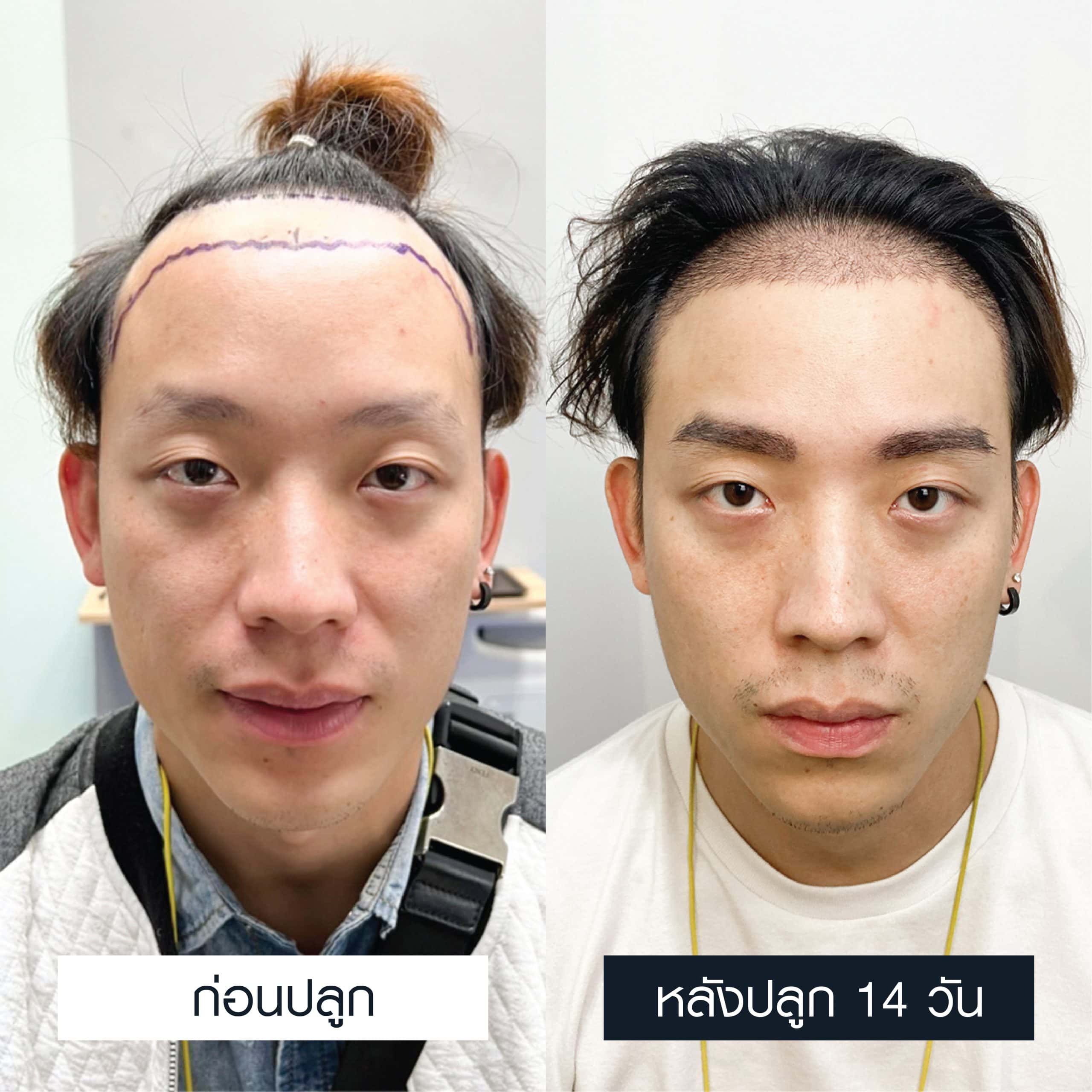 รีวิวเปรียบเทียบก่อนและหลังการปลูกคิ้ว 600 กราฟ 14 วัน