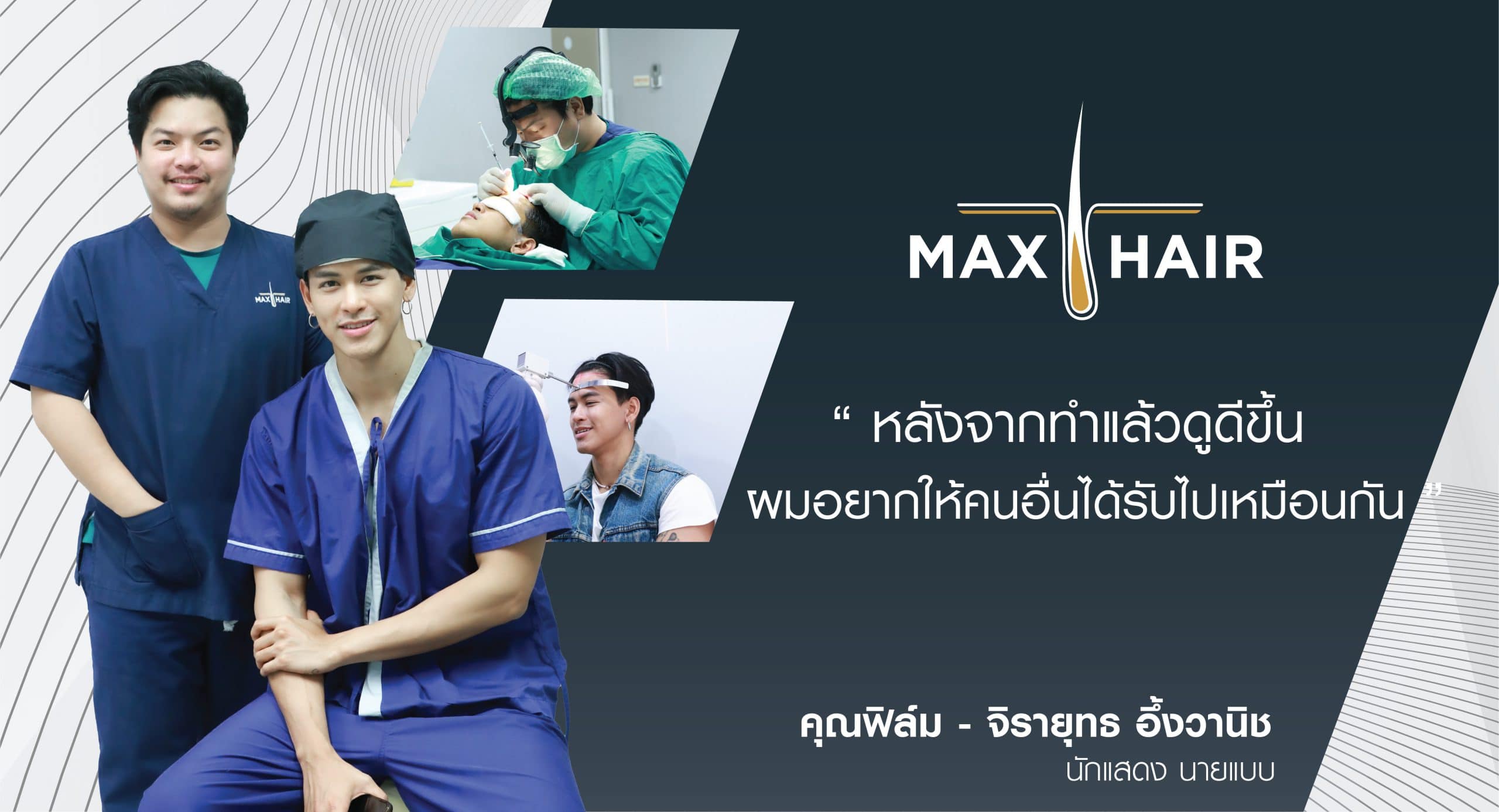 คุณฟิล์ม-จิรายุ กับผลลัพธ์ความพึงพอใจหลังปลูกผมที่ MAX-HAIR