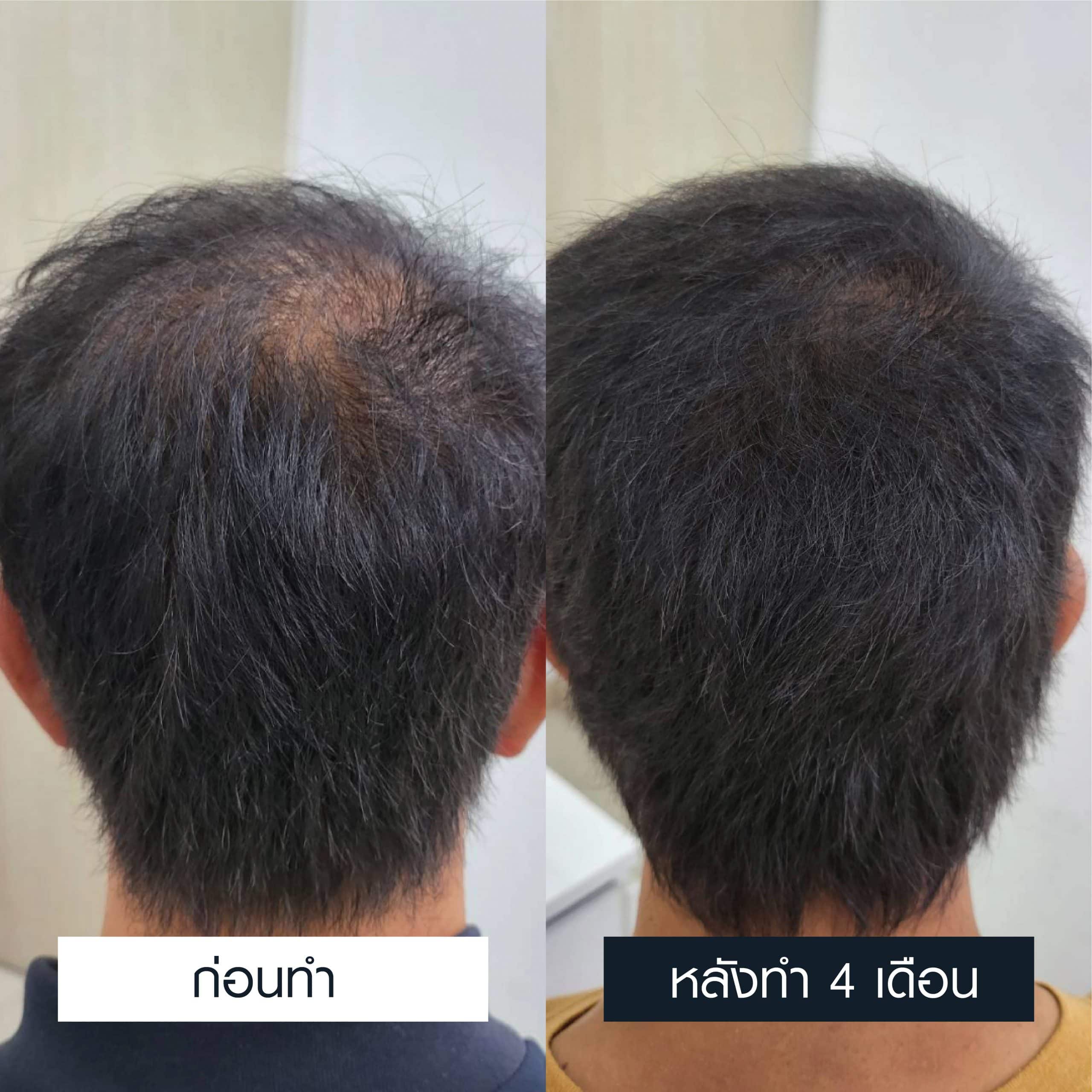 รีวิวก่อนและหลังการรักษาผมบางนาน 4 เดือน