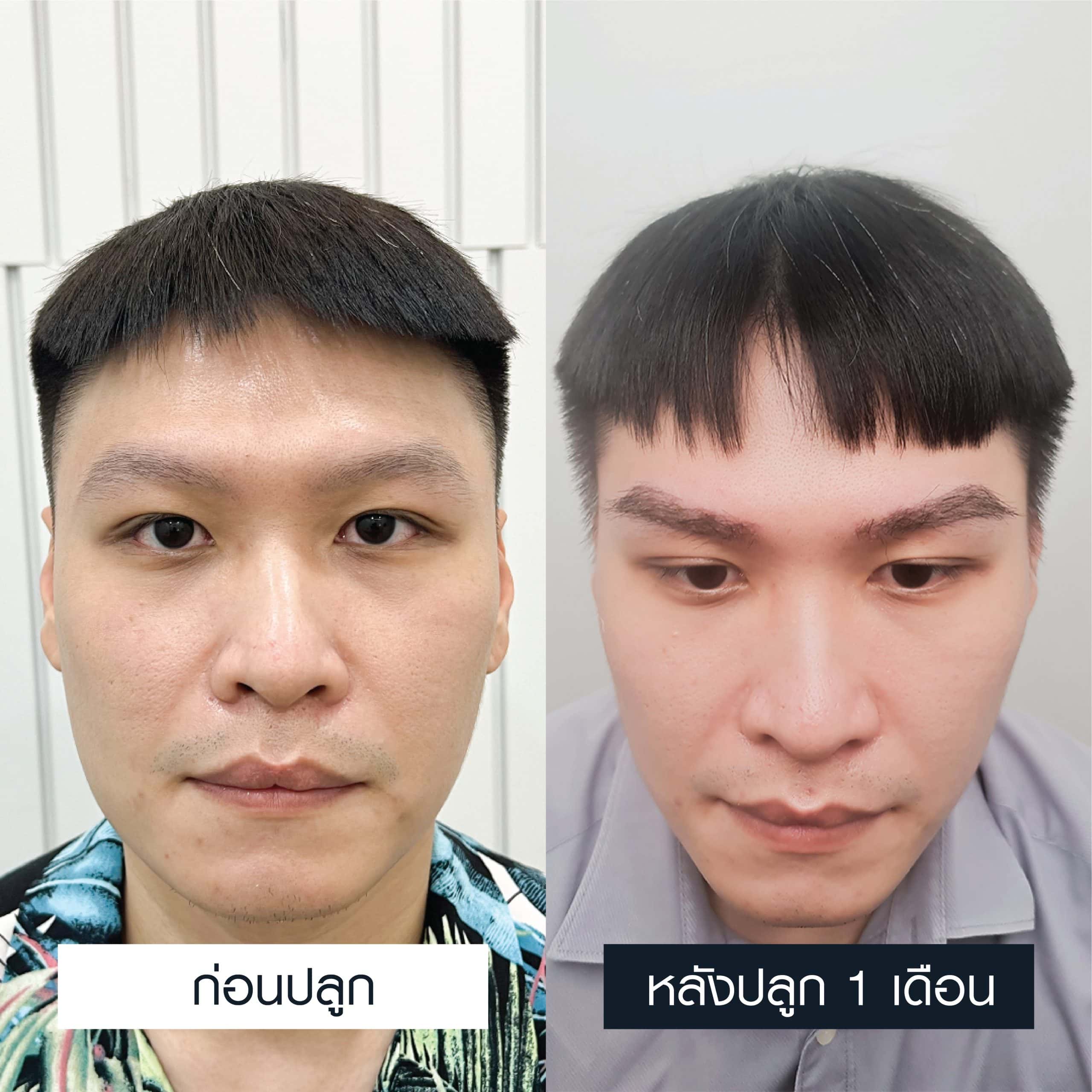 เปรียบเทียบความเปลี่ยนแปลงก่อน-หลังการปลูกคิ้ว 1 เดือน