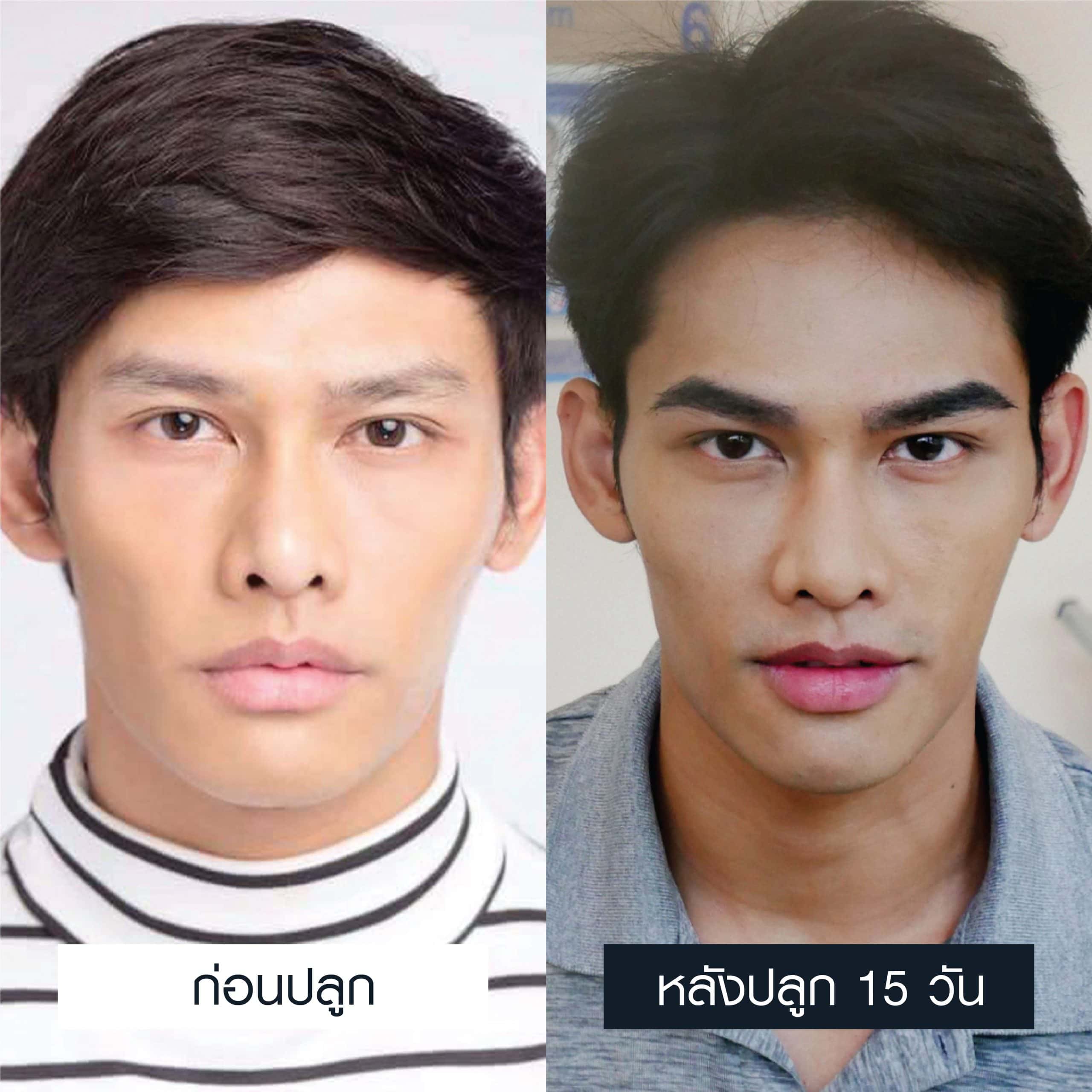 Male eyebrow transplant results 600 grafts after 15 days