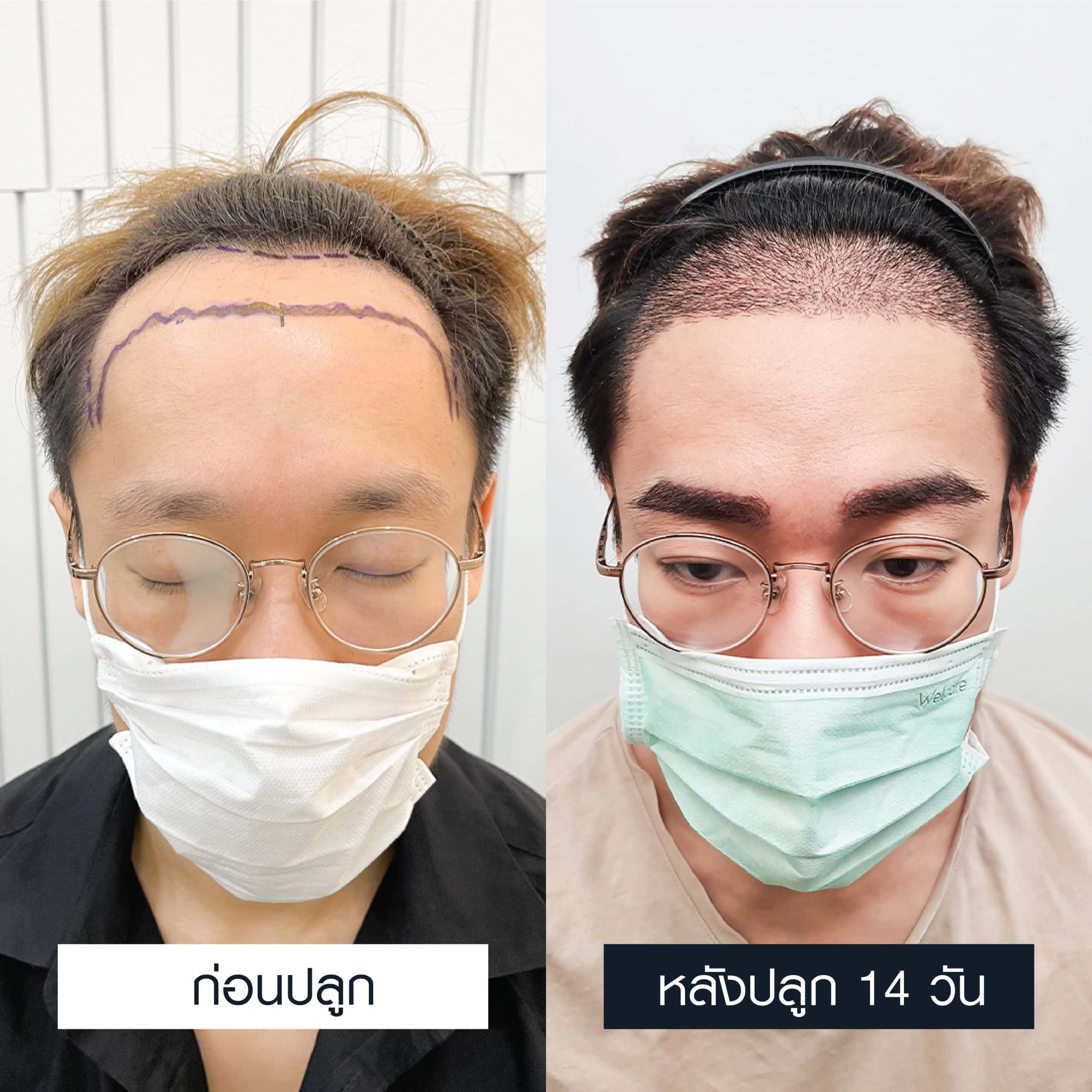 เปรียบเทียบก่อนและหลังปลูกคิ้ว 600 กราฟต์หลังผ่านไป 14 วัน