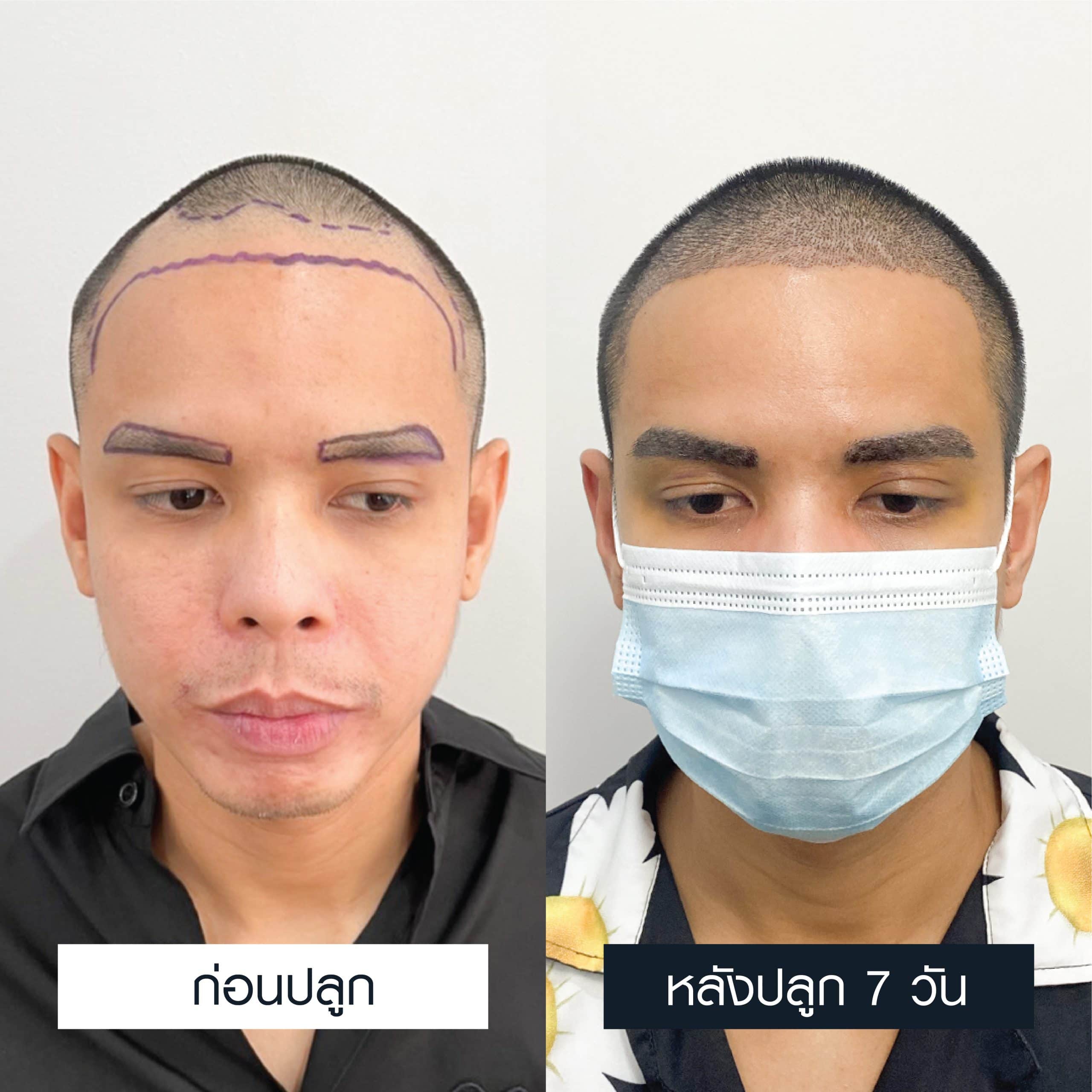 เปรียบเทียบก่อนและหลังผ่านไป 7 วันของการปลูกคิ้วผู้ชาย MCG 600 กราฟต์