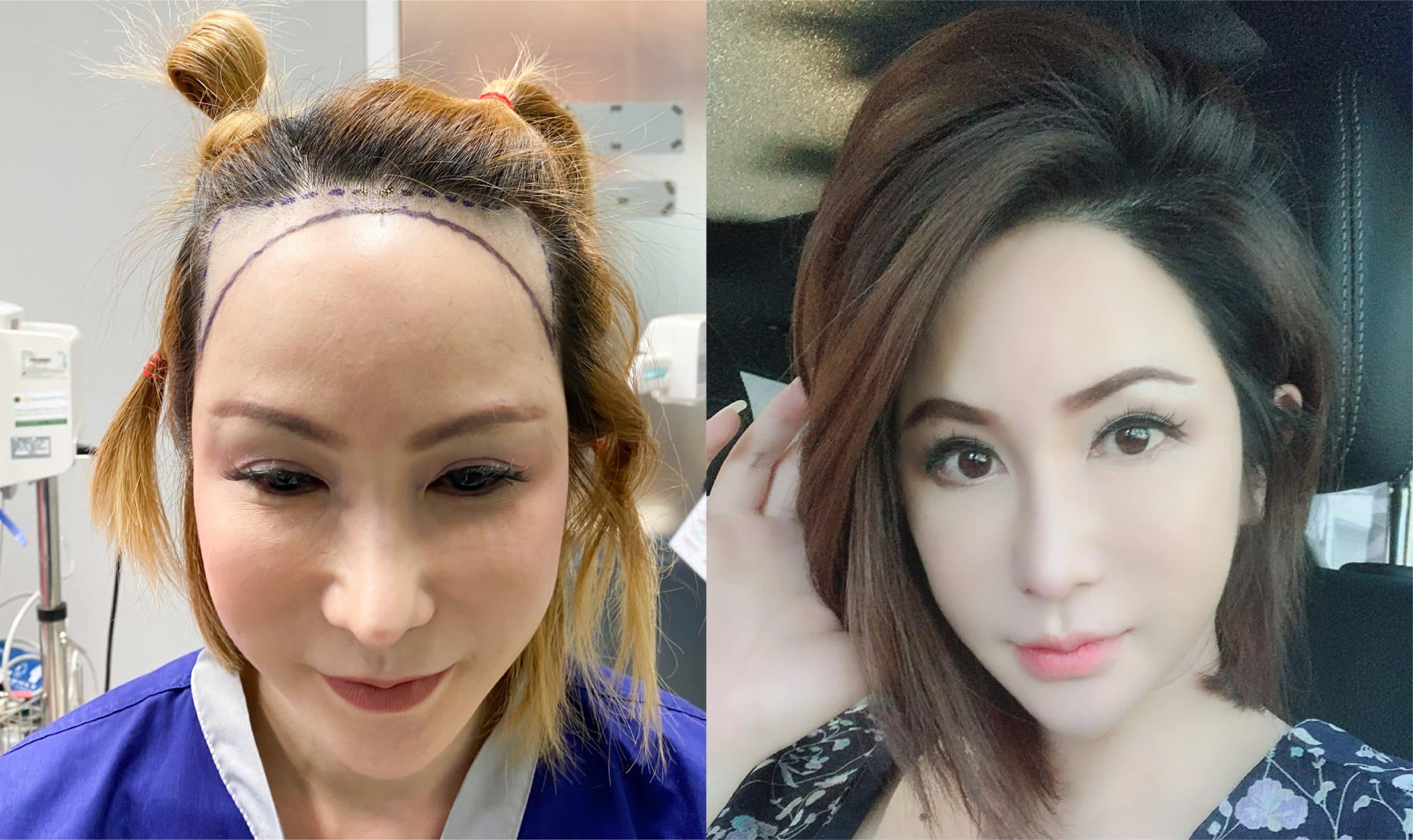 รีวิวการปลูกผมจากคุณนิกกี้ ณัฐณิชา สกุลจารุพงศ์ (พริตตี้)
