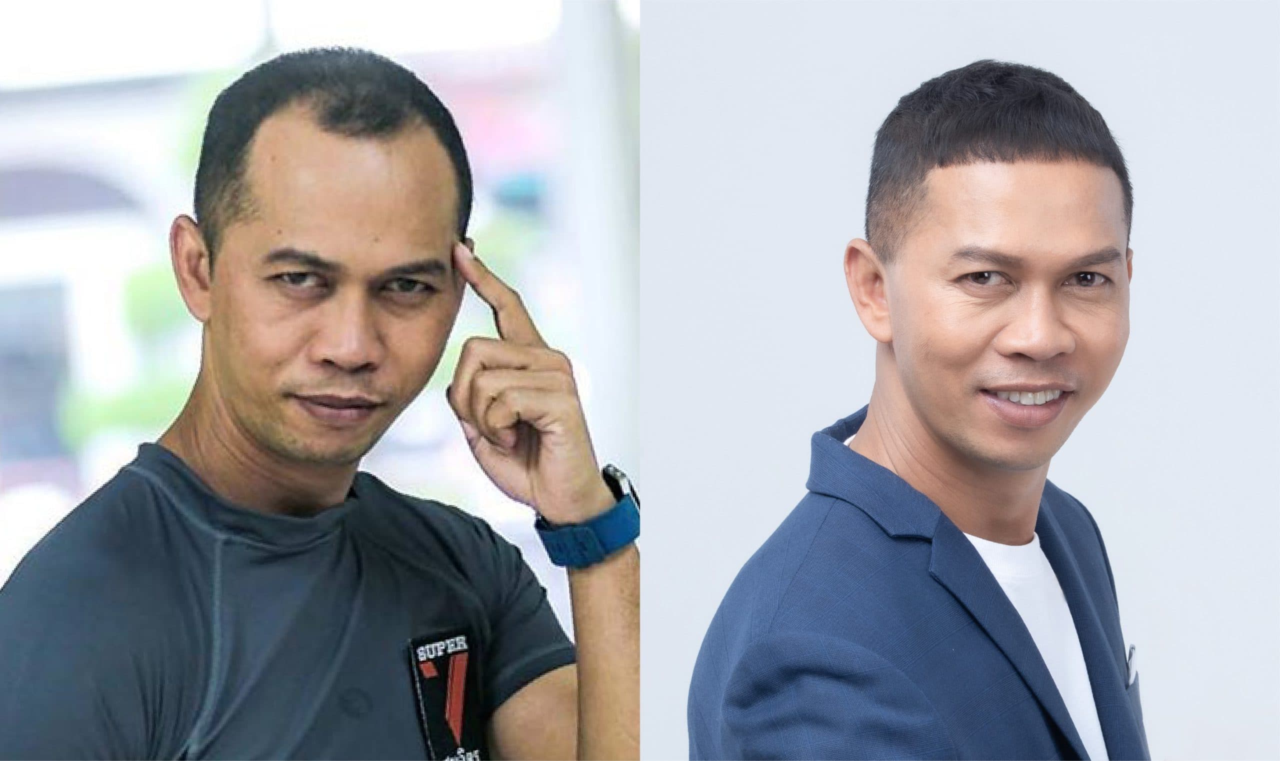 คุณสมจิตร จงจอหอ (นักมวยเหรียญทองโอลิมปิก) เลือก Max Hair Clinic
