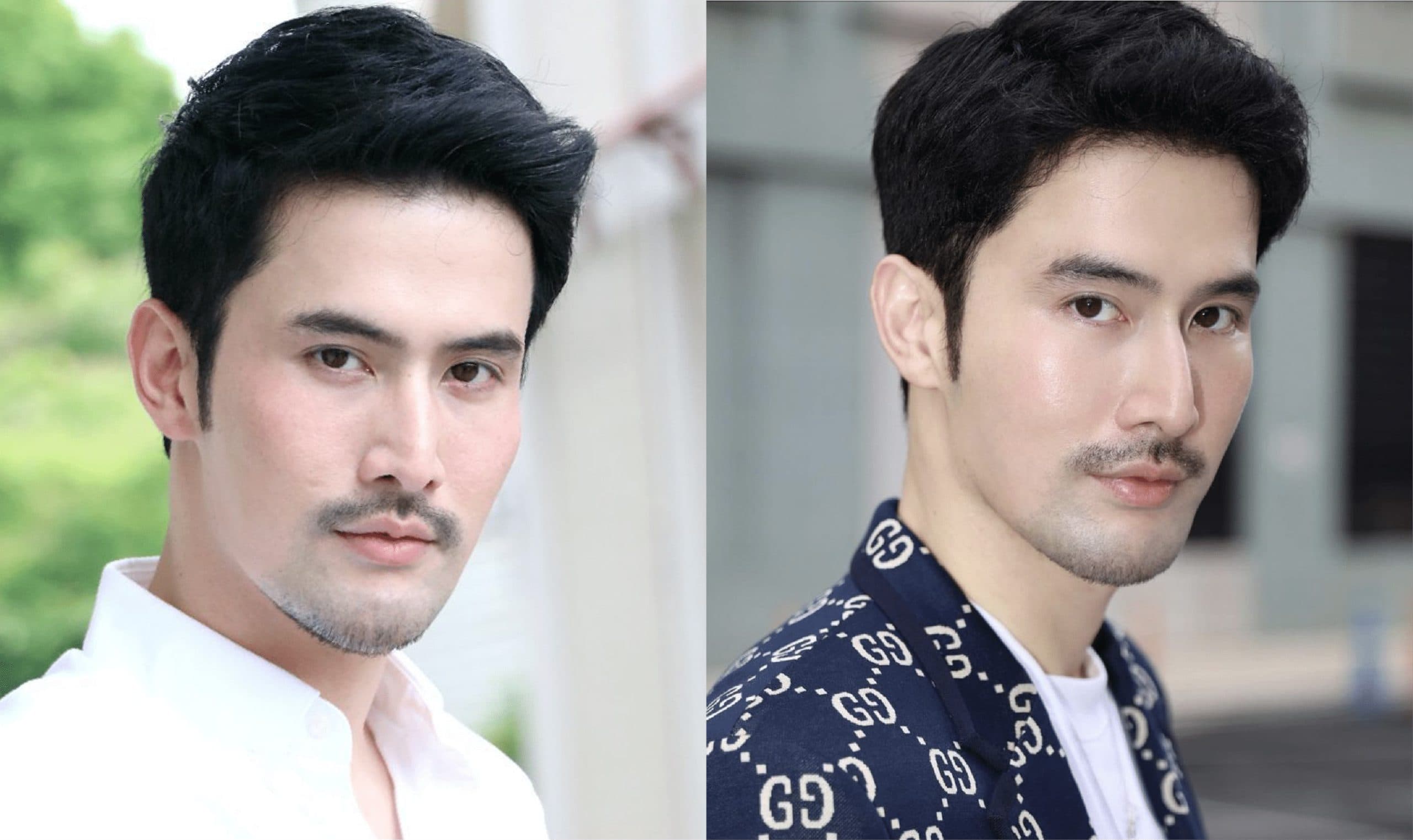 ภาพผลลัพธ์การปลูกผมถาวรของธีร์ วณิชนันทธาดา