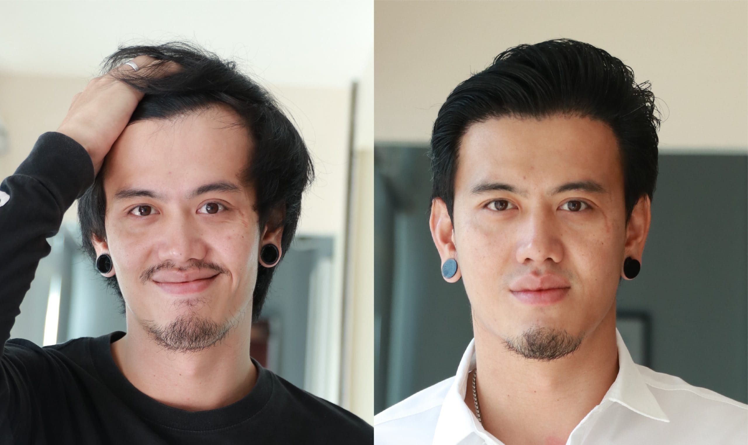 รีวิวปลูกผมของดารา-ศิลปิน เคสคุณทาร์ท อรรถพล (นักร้องนำ วง ทีที)