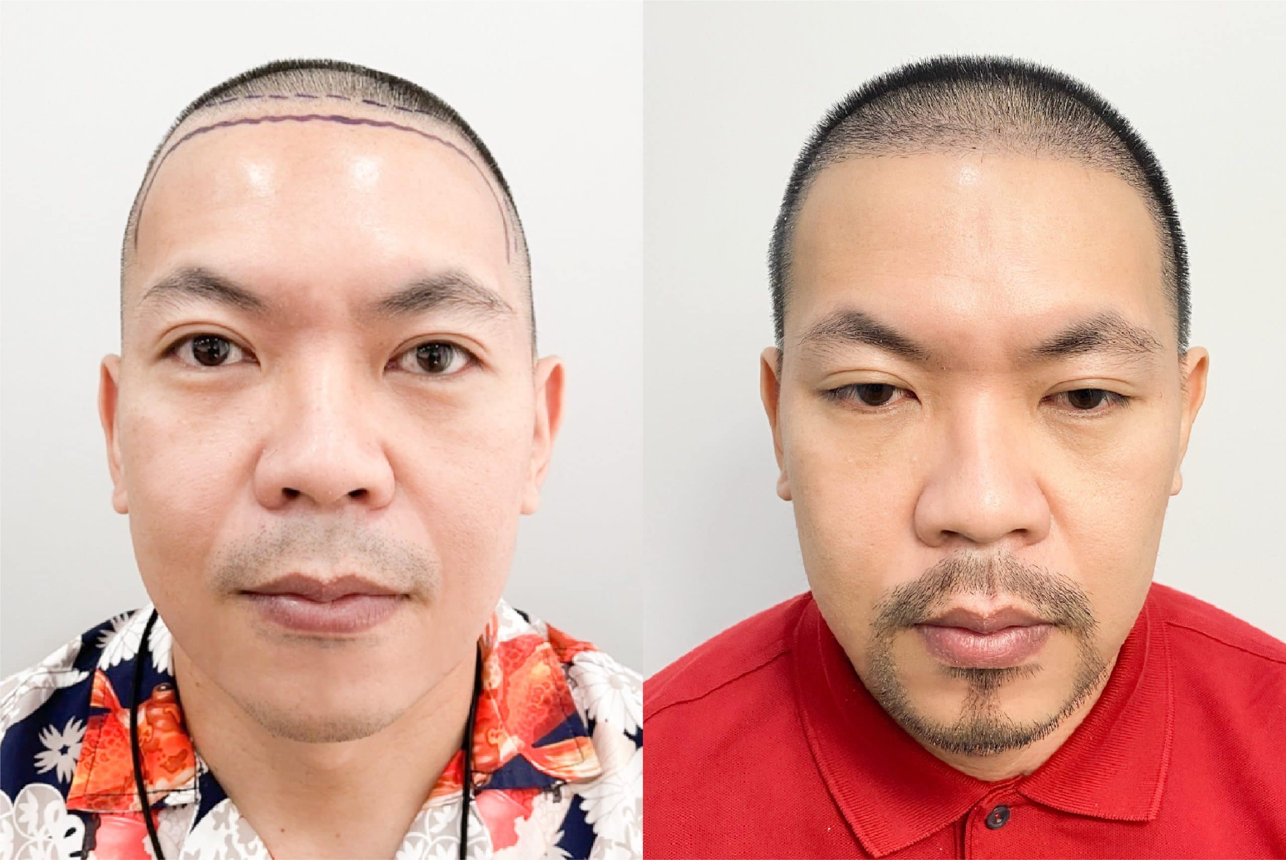 รีวิวจากผู้ชายที่เข้ารับบริการปลูกผมถาวร