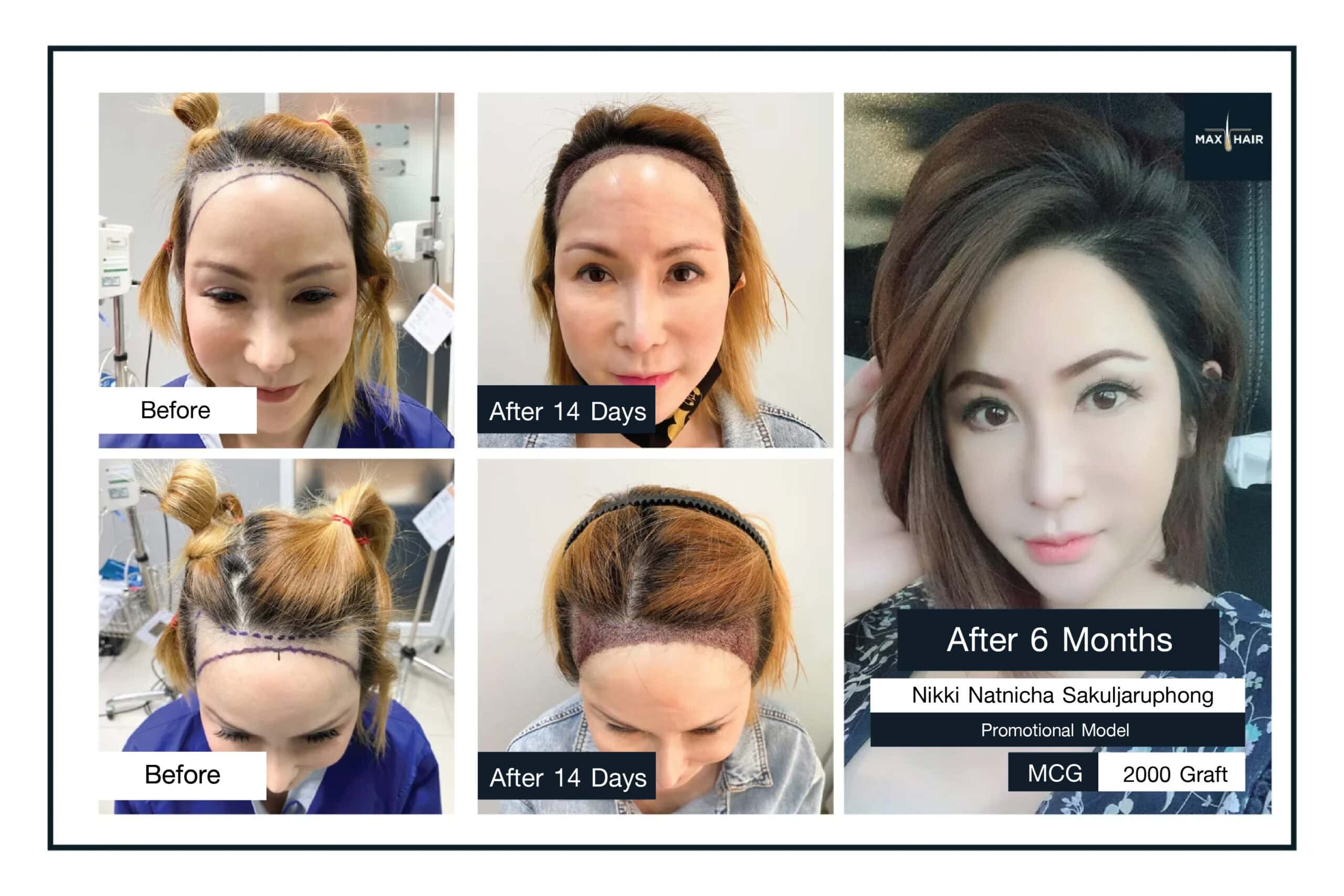 Hair transplant results review of Nikki Natnicha Sakuljaruphong