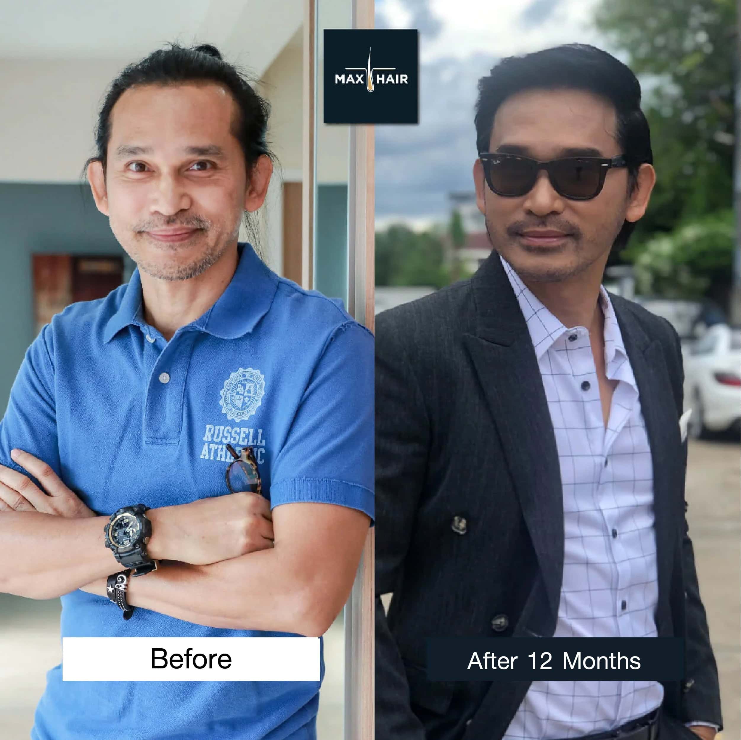 Visible transformation in man after 12 months of hair transplant, from casual to confident look.