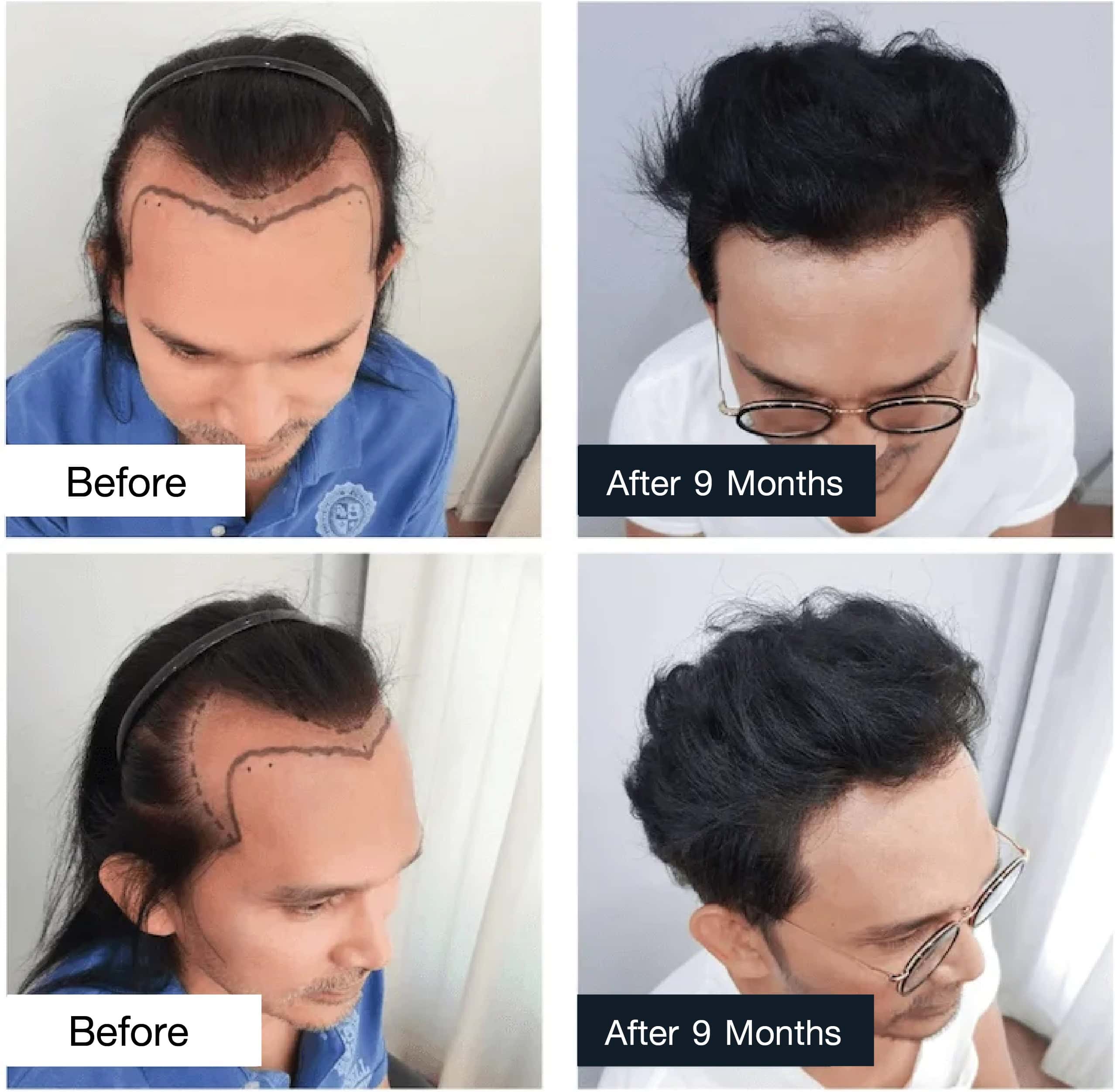 Results of hair transplant for Prab Pradappong, 9 months