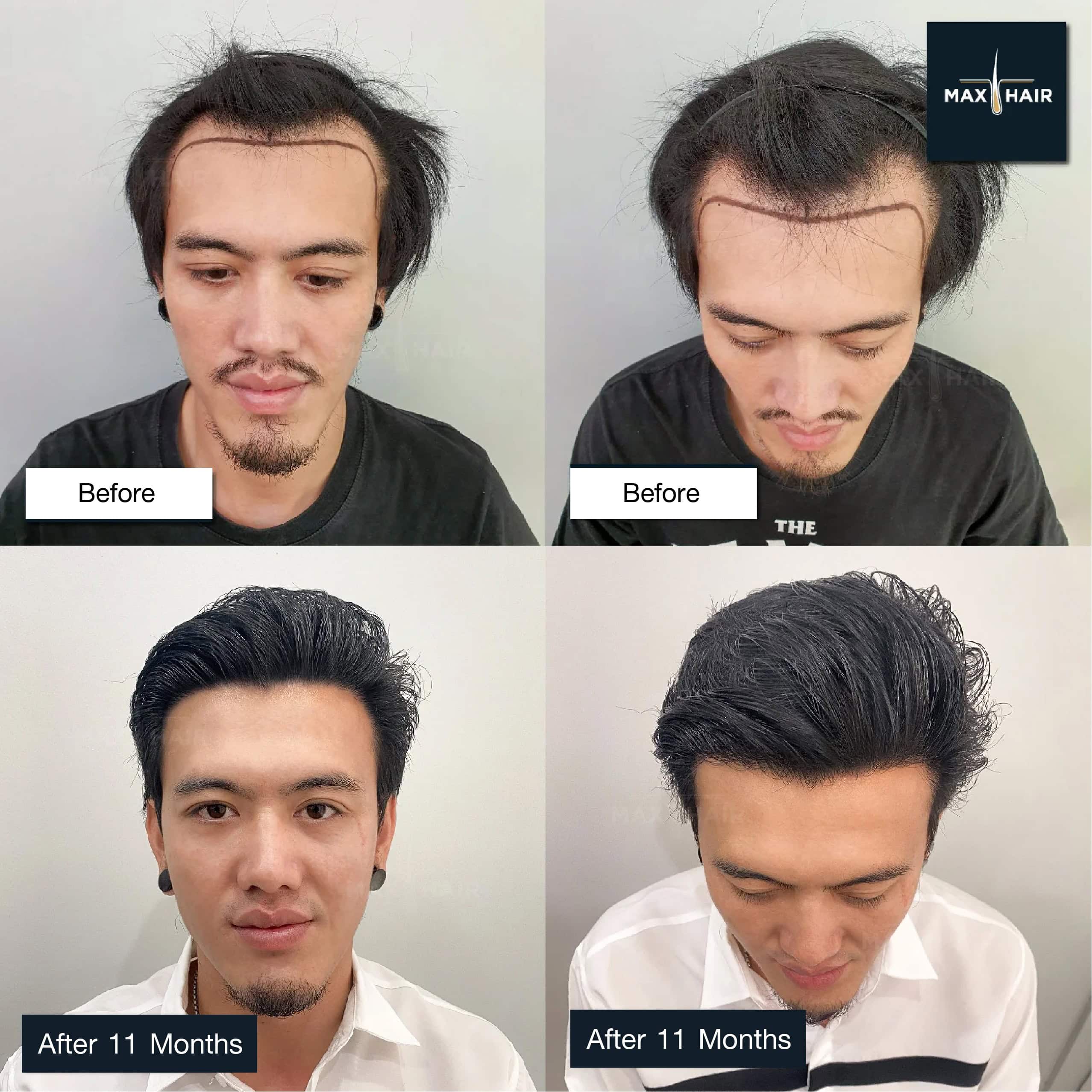 Lead singer Tart Atthaphon of TT band hair transplant review and results