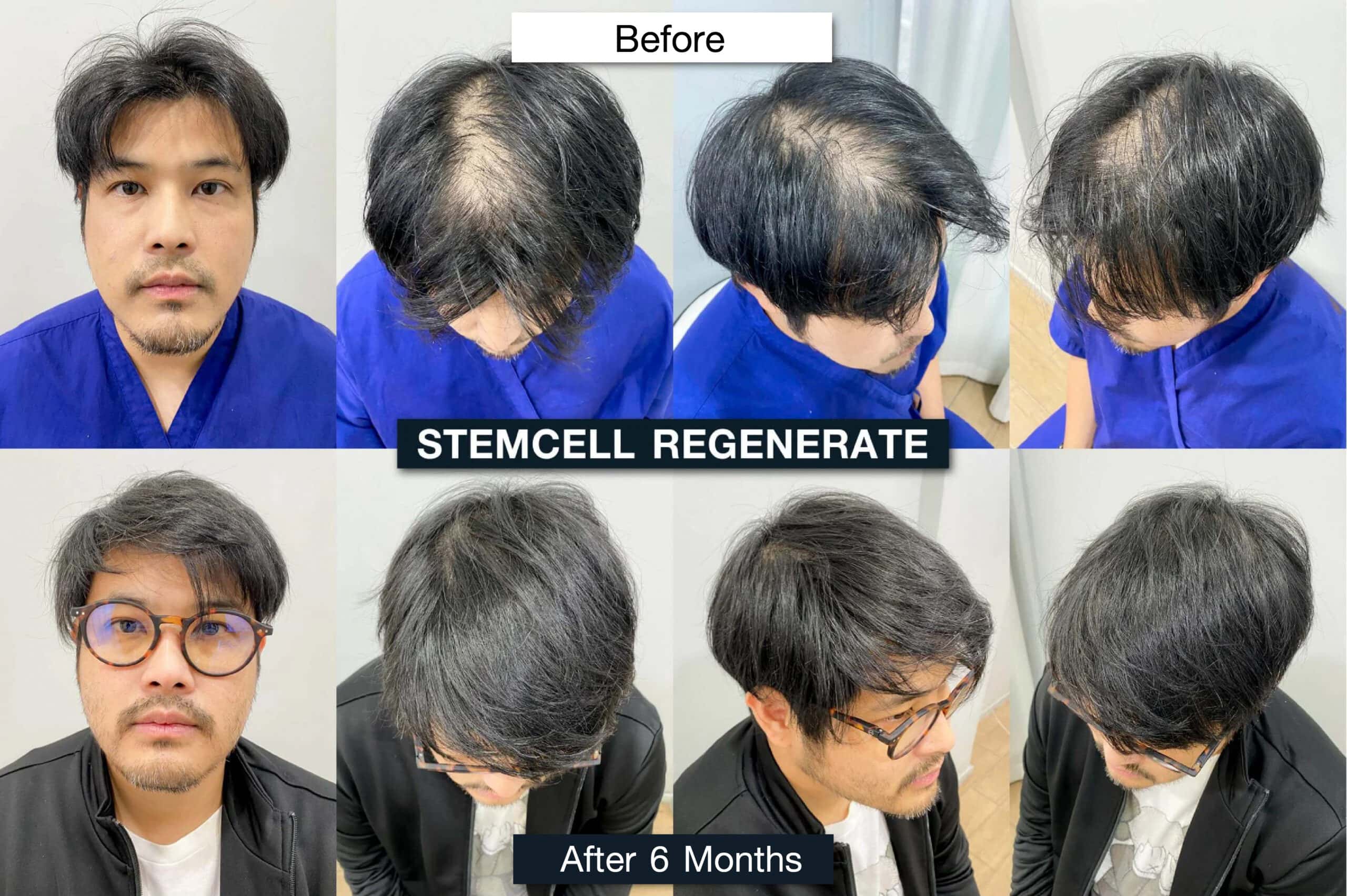 Producer and director Tawan Jarujinda permanent hair transplant case review result
