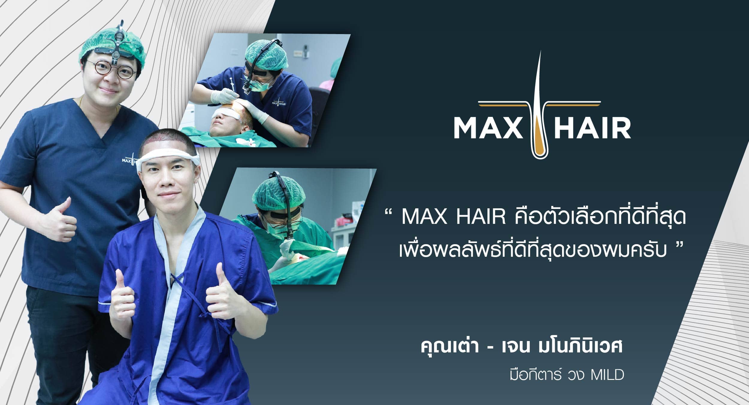 รีวิวปลูกผม คุณต่า-เจน มโนภินิเวศ มือกีตาร์วง Mild