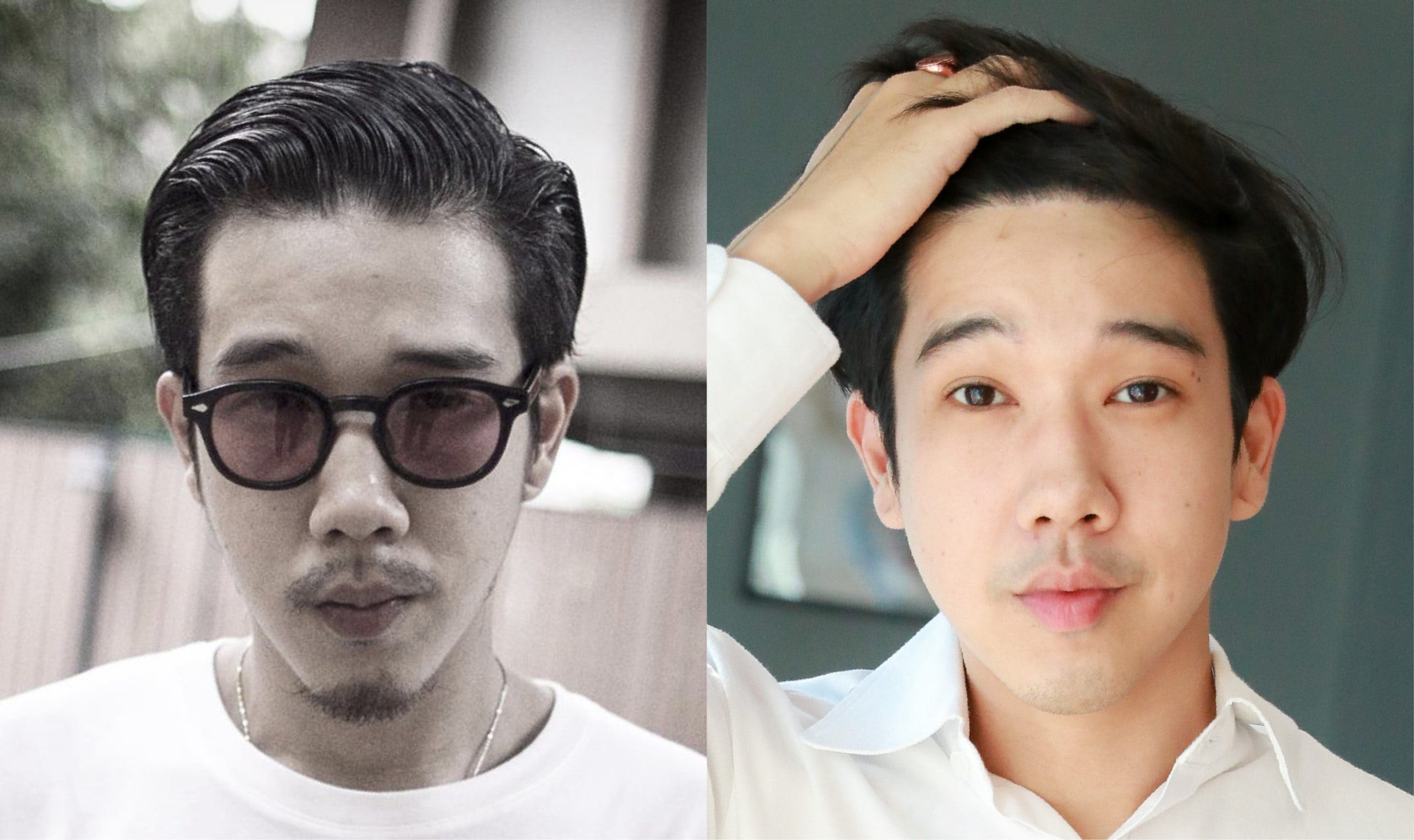 รีวิวการปลูกผมผู้ชาย คุณต๋า ศุภโชค เตือนจิตต์