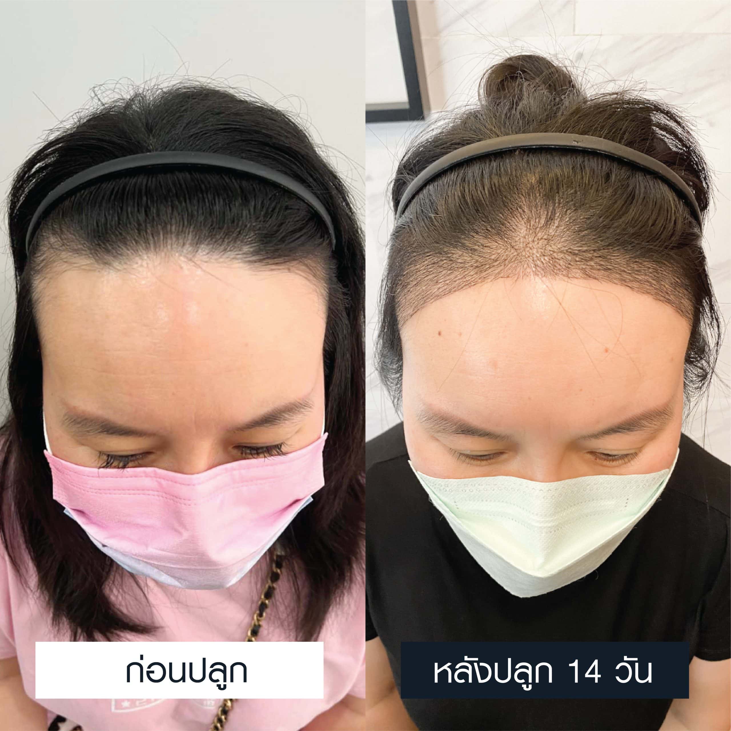 รีวิวปลูกผมผู้หญิงแบบ FUE 3,200 กราฟ ก่อน-หลังปลูก 14 วัน