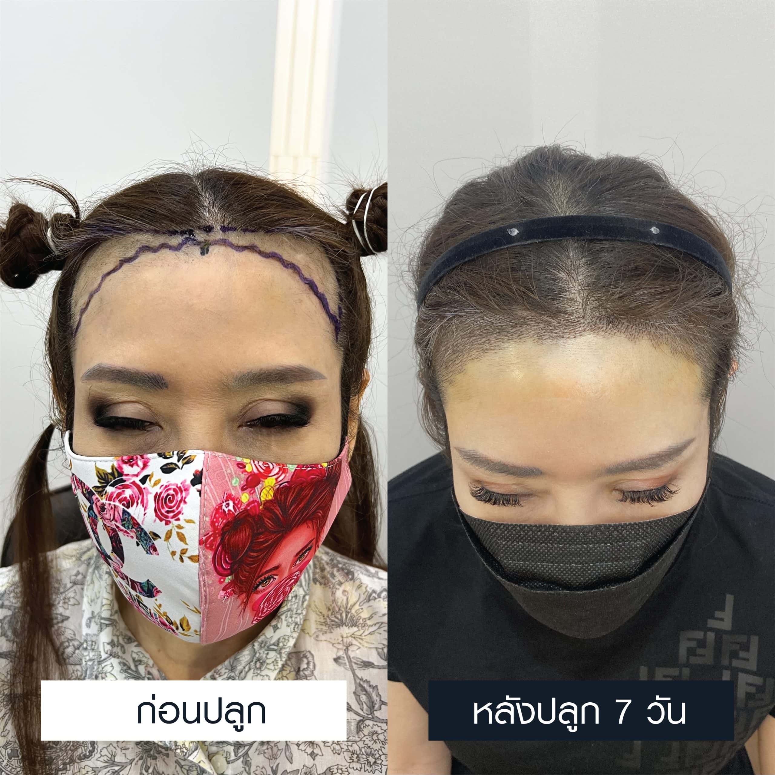 รีวิวก่อนและหลัง 7 วันของการปลูกผมแก้ปัญหาผมบางสำหรับผู้หญิง
