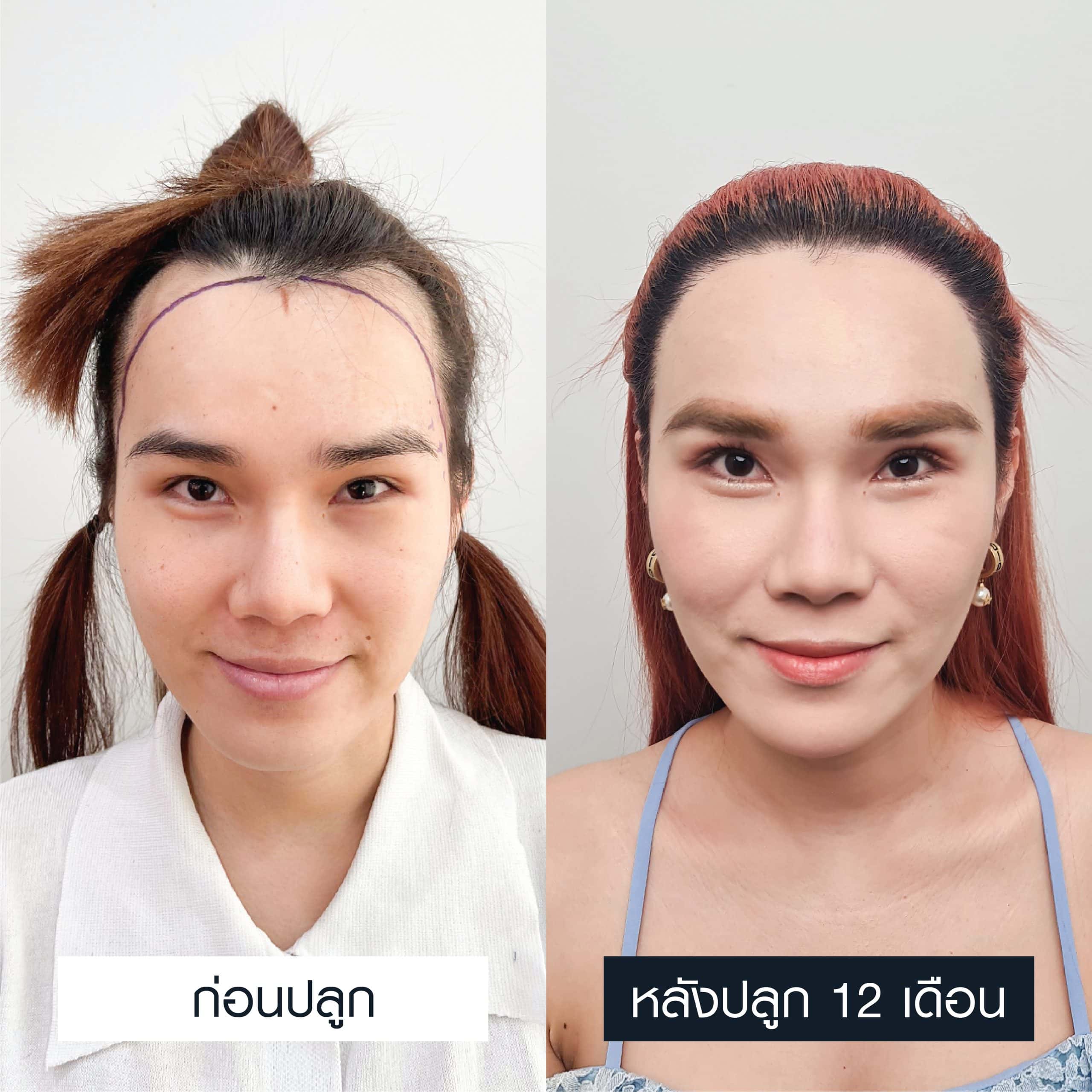 รีวิวปลูกผมผู้หญิงเทคนิค FUE 2,500 กราฟต์
