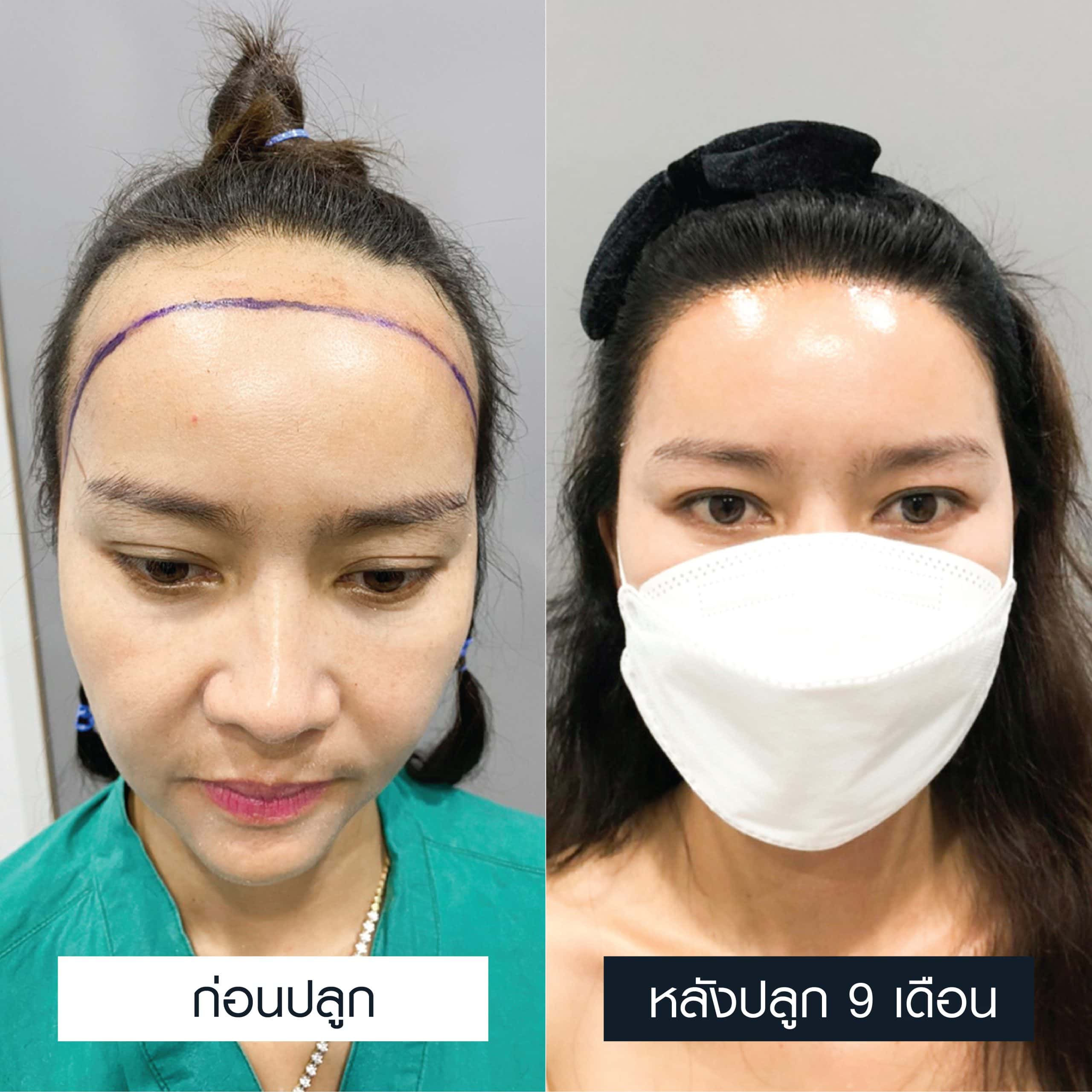 เปรียบเทียบก่อนและหลังผ่านไป 9 เดือนของปลูกผมผู้หญิง MCG 2,500 กราฟต์