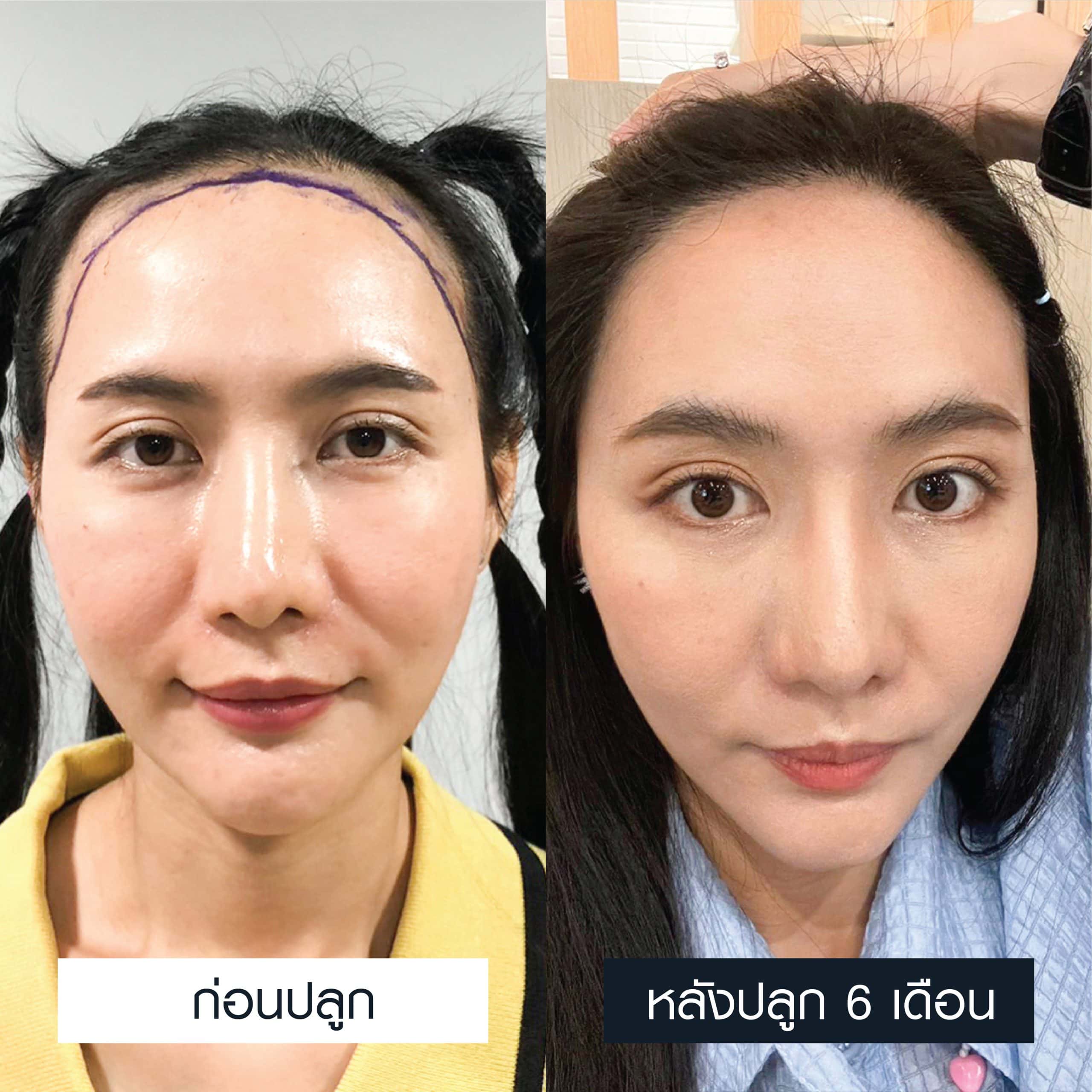 รีวิวปลูกผมผู้หญิงเทคนิค MCG 2,000 กราฟต์