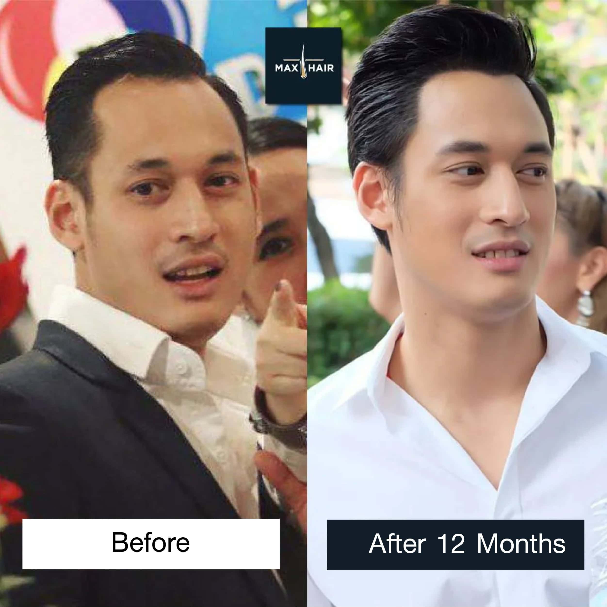 Before and after 12 months hair transplant results of Phon