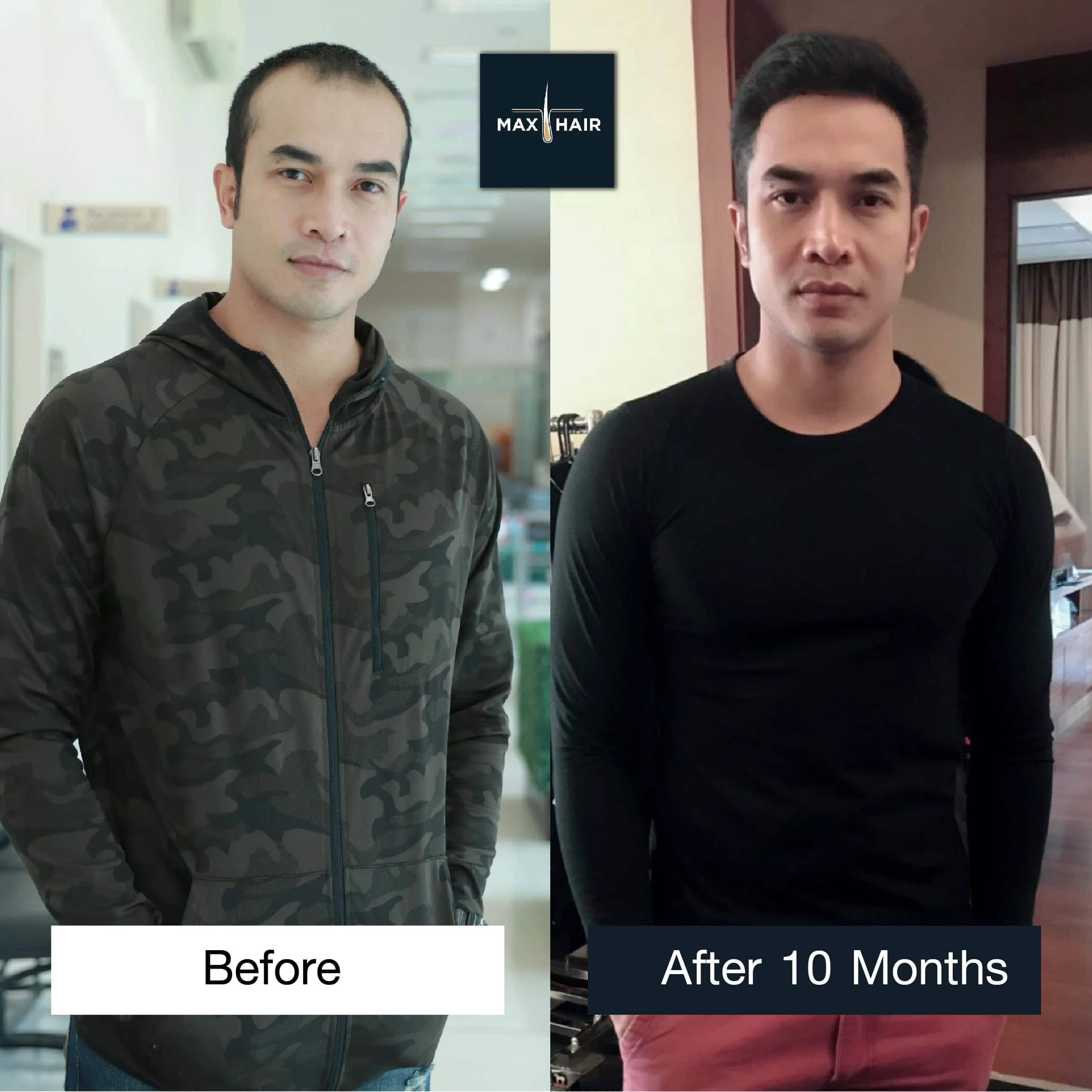 Photo showing Ran Nawarat before and after a hair transplant