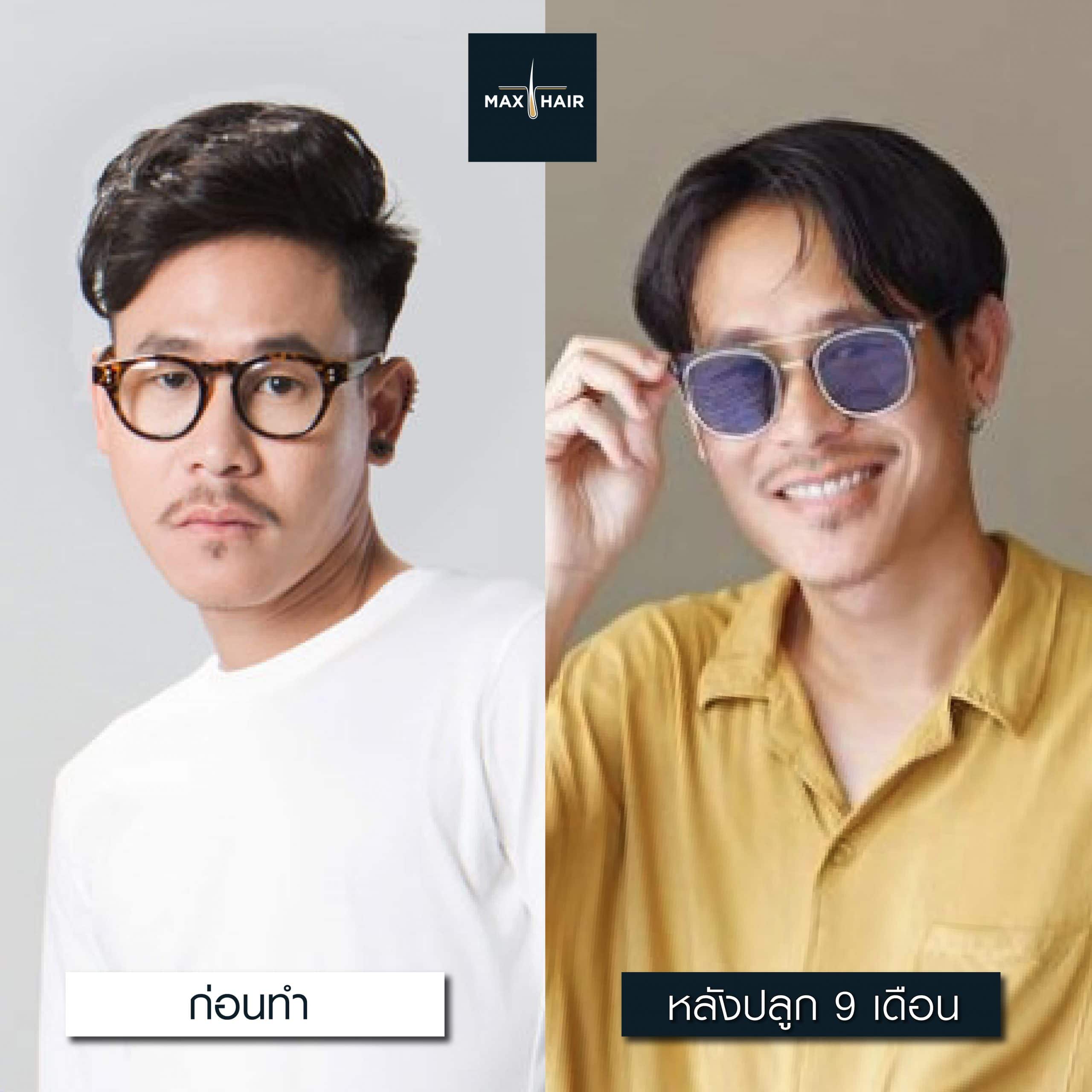 รีวิวการปลูกผมของ เท็น-ชาครีย์ ก่อนและหลังทำ 9 เดือน