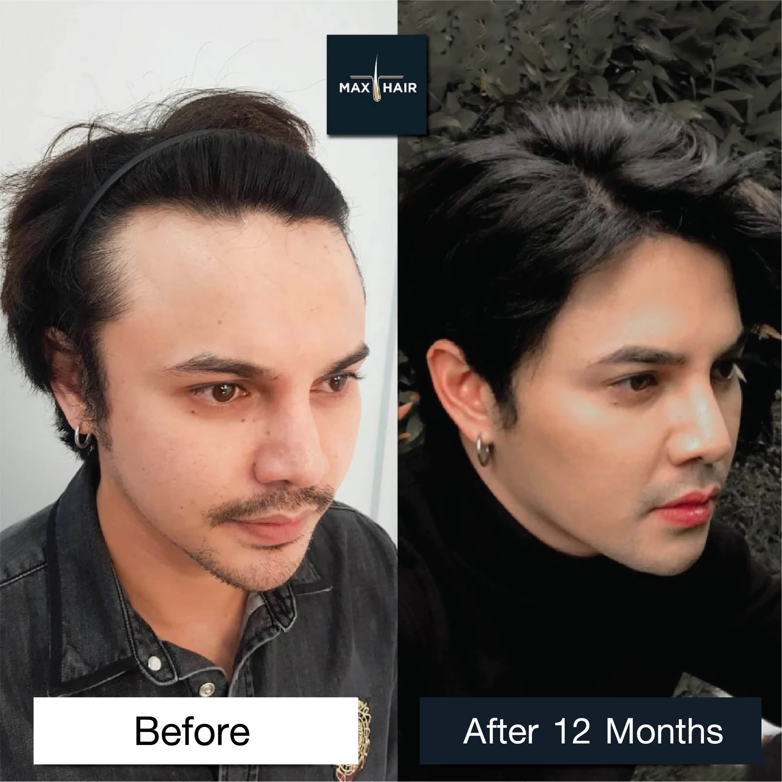 Phaisan Khunnu hair transplant results after 12 months