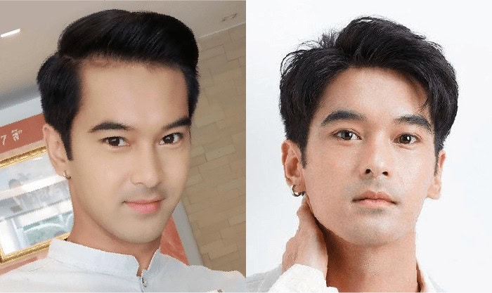 รีวิวปลูกผมจากคุณออฟ-ชนะพล นักแสดงช่อง 7
