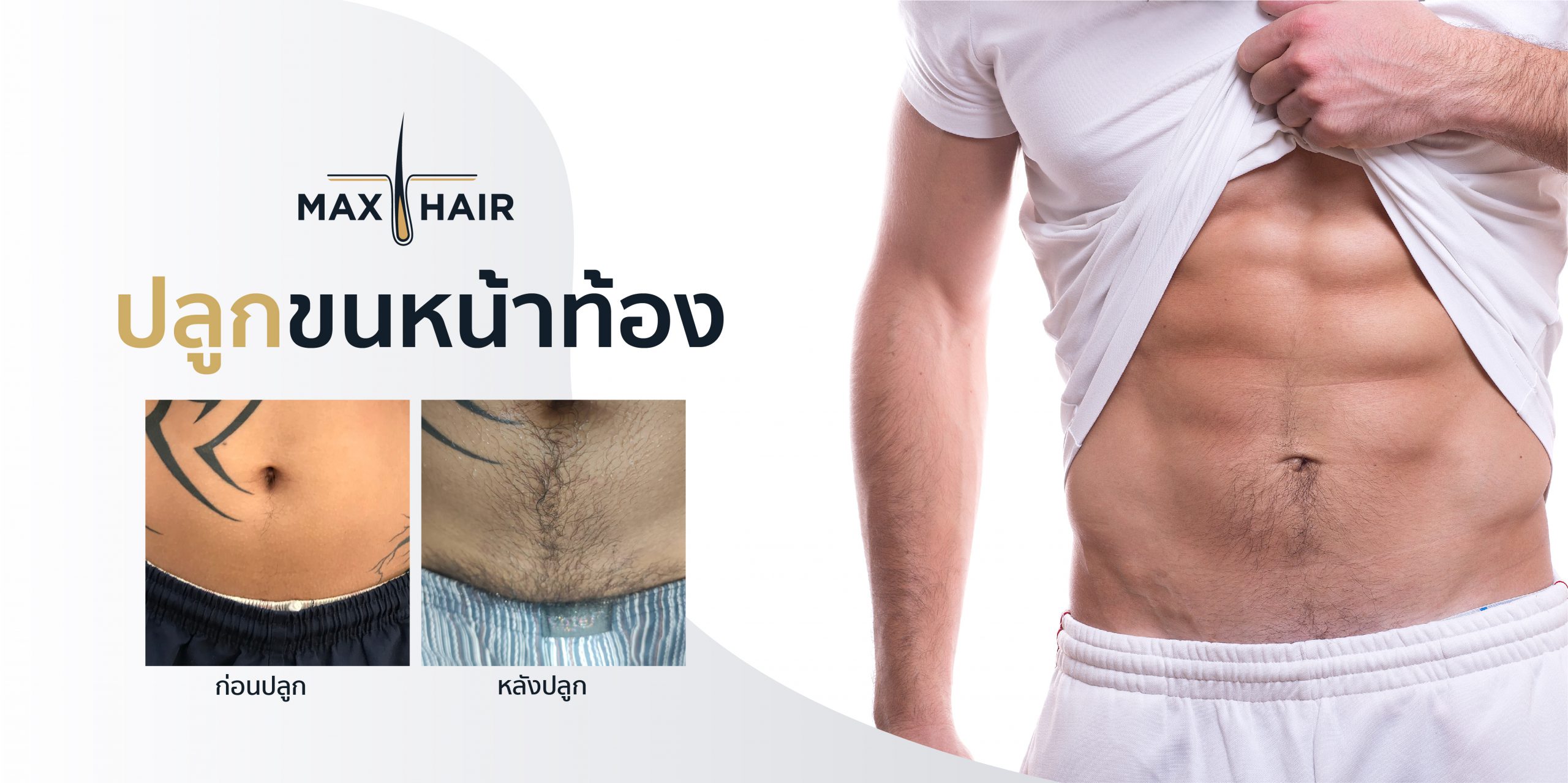 บริการปลูกขนหน้าท้องโดยแพทย์ที่ Max Hair