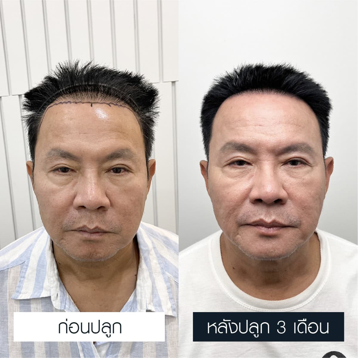 รีวิวปลูกหนวด คุณจาตุรงค์ มกจ๊ก (นักแสดงตลก)