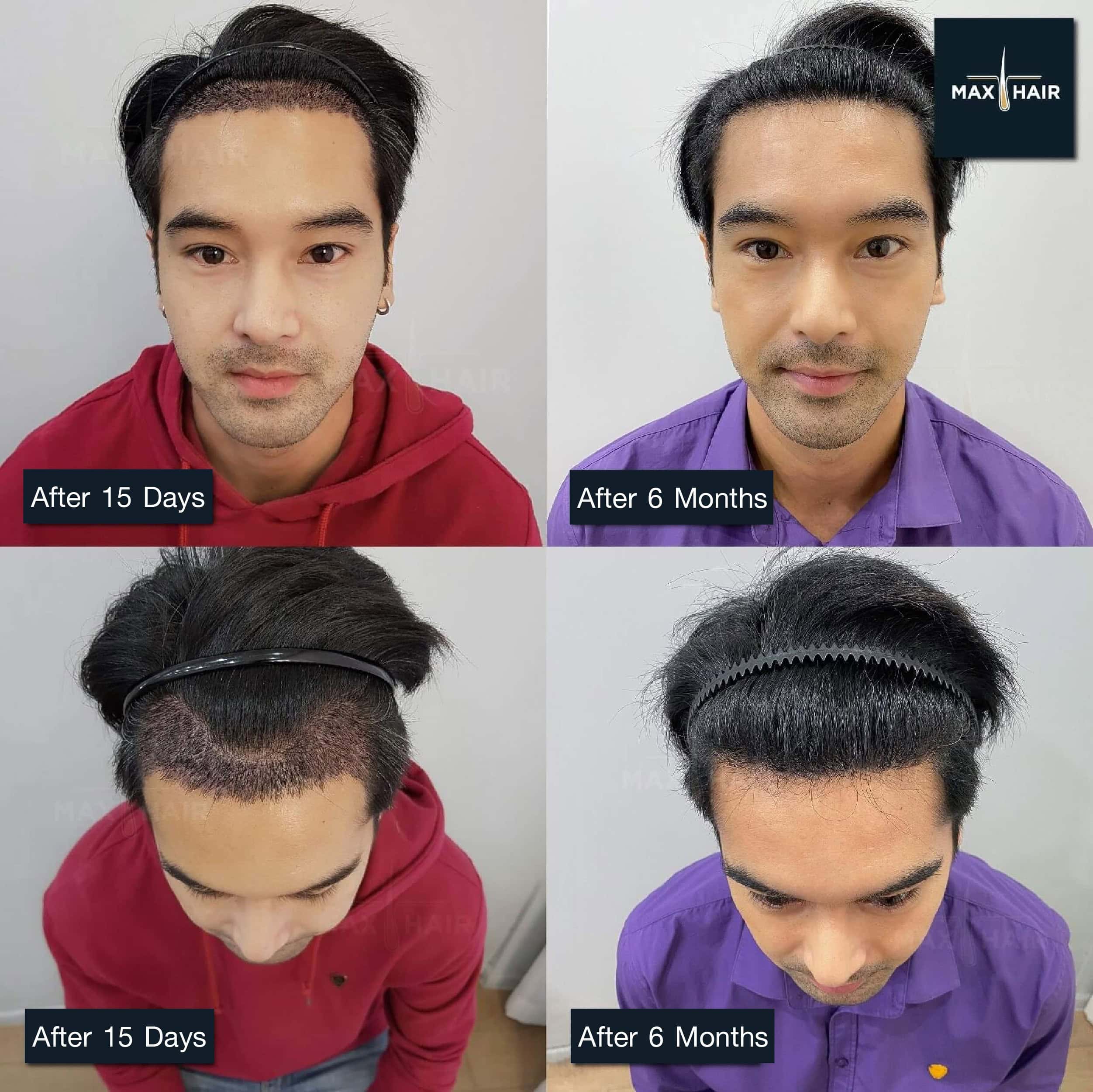 Channel 7 actor Off Chanaphon Sattaya's permanent hair transplant review results