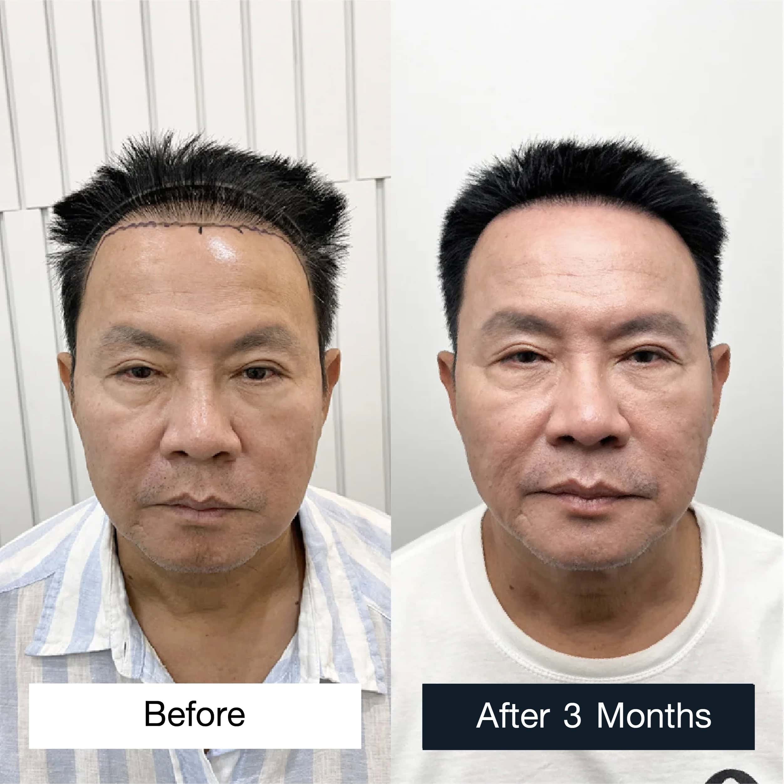 a male hair transplant for Khun Chaturong Mokjok, an actor