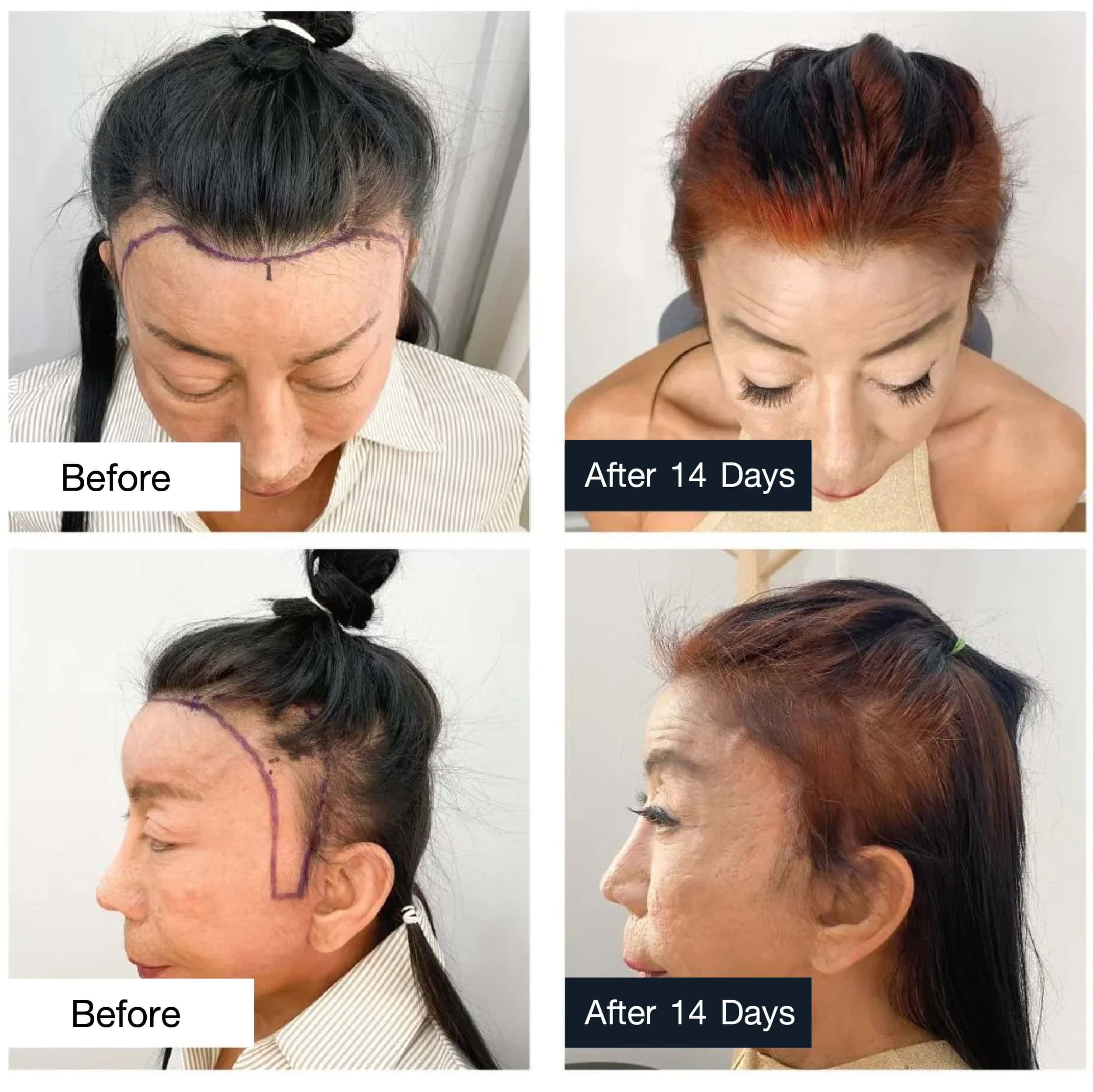 review before and after hair transplant: Khun Sitang