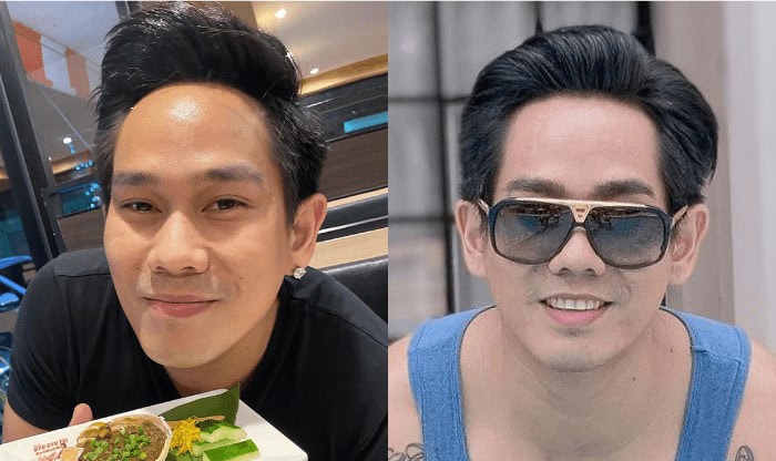 คุณอาร์ นักแสดง เข้ารับบริการปลูกผมที่ Max Hair Clinic
