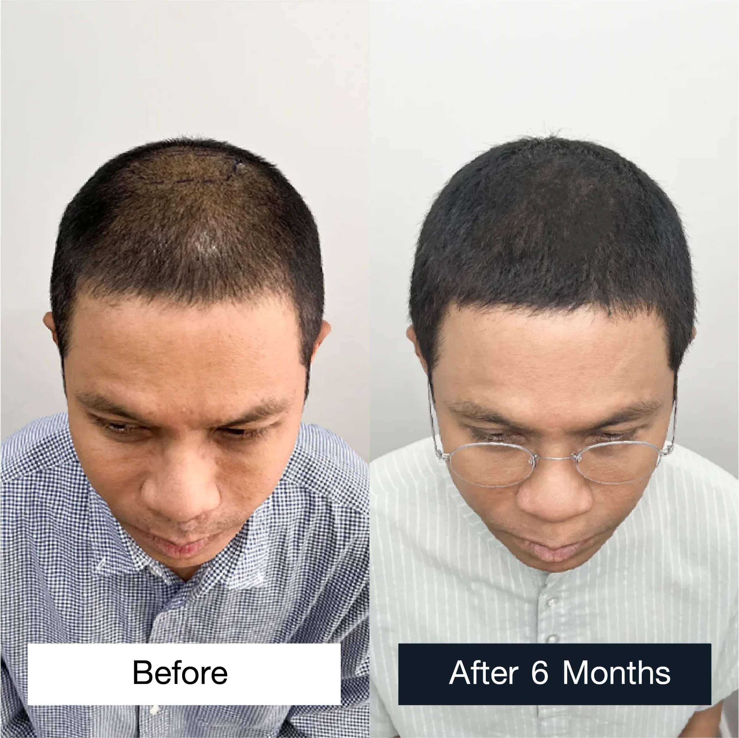 Musician Nueng Jakkrawan permanent hair transplant case review and transformation