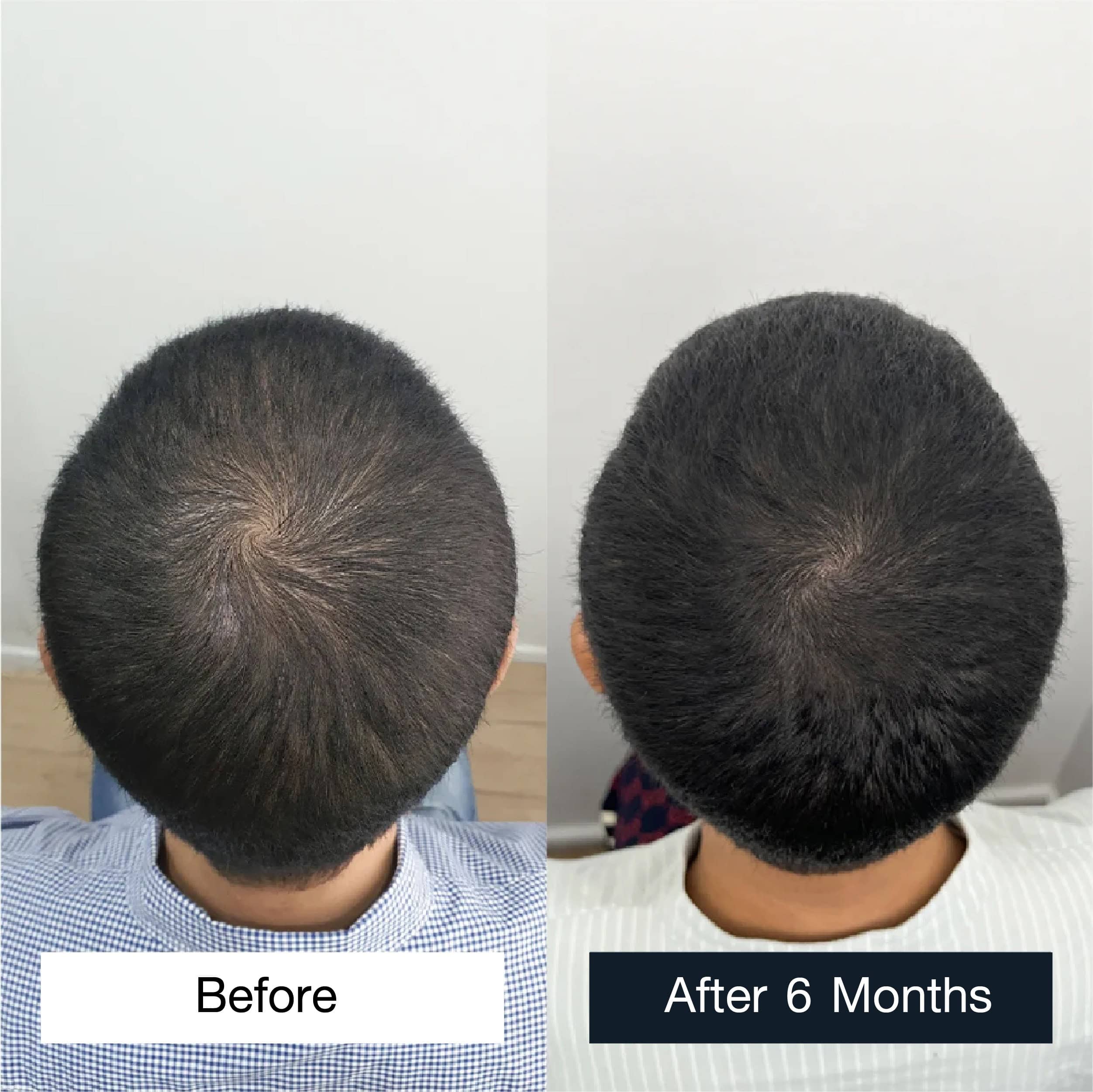 Musician Nueng Jakkrawan permanent hair transplant case review and transformation - top view
