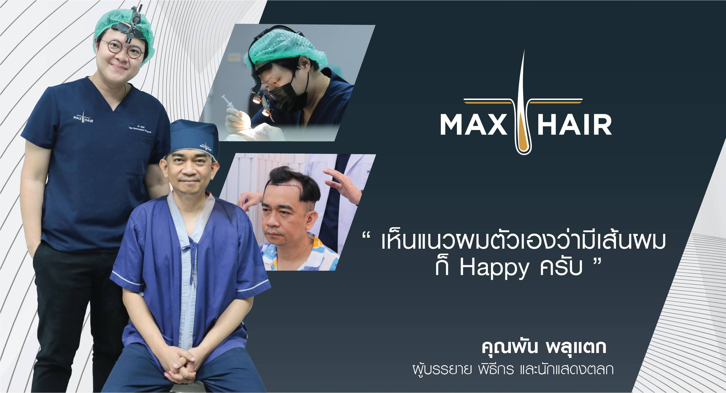 รีวิวปลูกผมผู้ชายเคสคุณพัน พลุแตก(พิธีกร และนักแสดงตลก)
