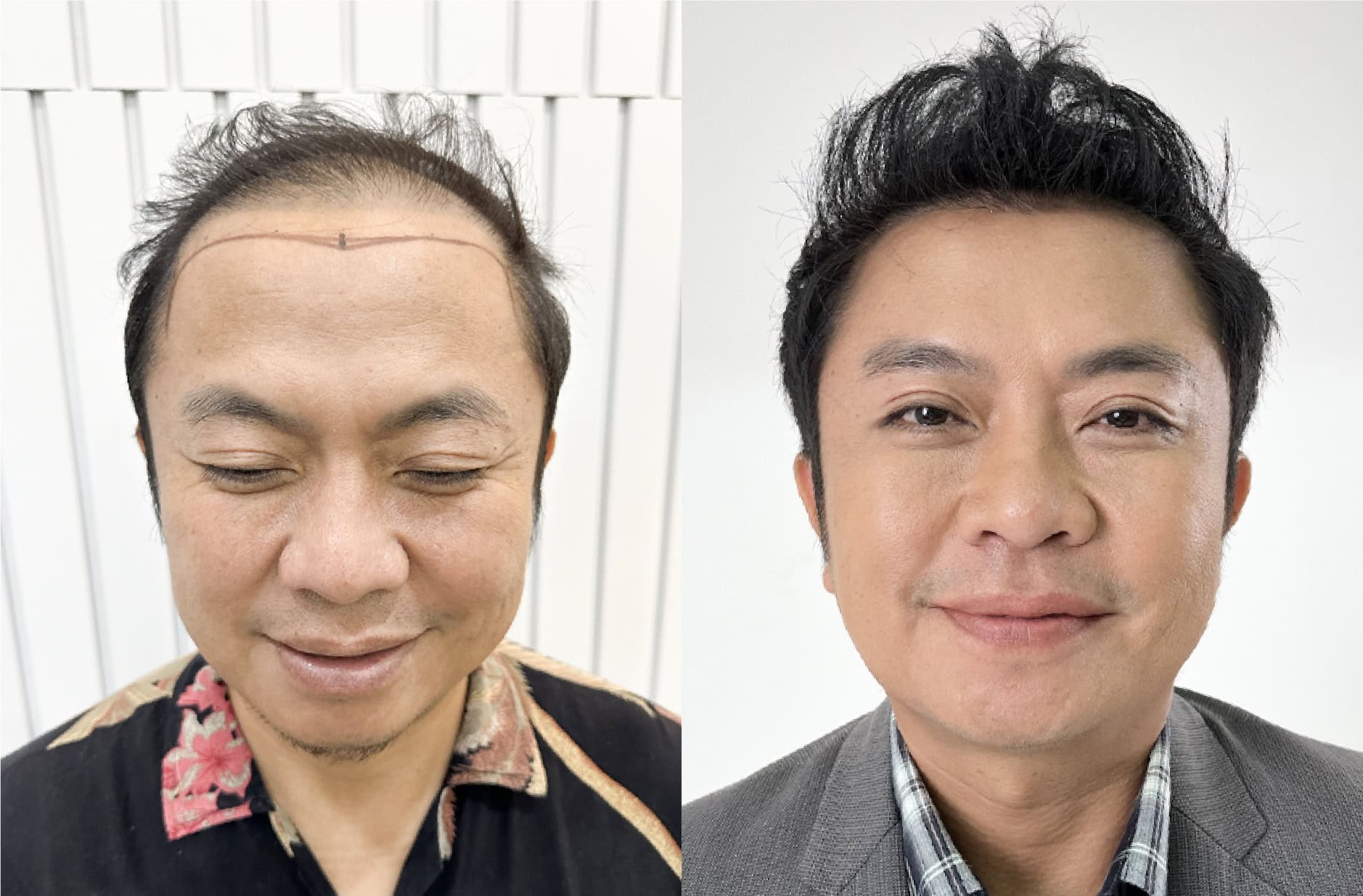 การตรวจสภาพและวางแผนการปลูกผมของ คุณอี๊ด โปงลางสะออน