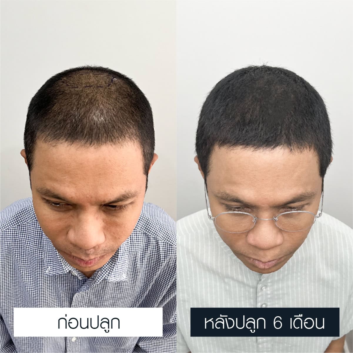รีวิวปลูกหนวด คุณหนึ่ง จักรวาล เสาธงยุติธรรม (นักดนตรี) (2)