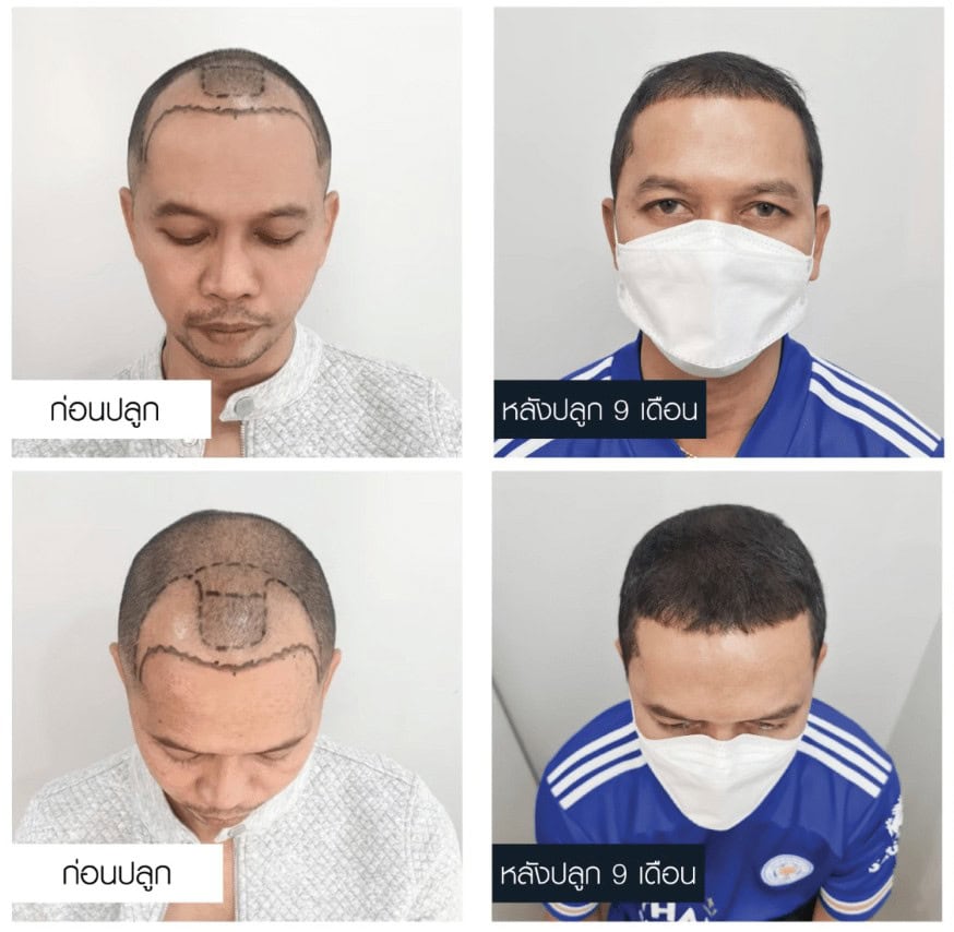 รีวิวปลูกผมคุณสมจิตร จงจอหอ