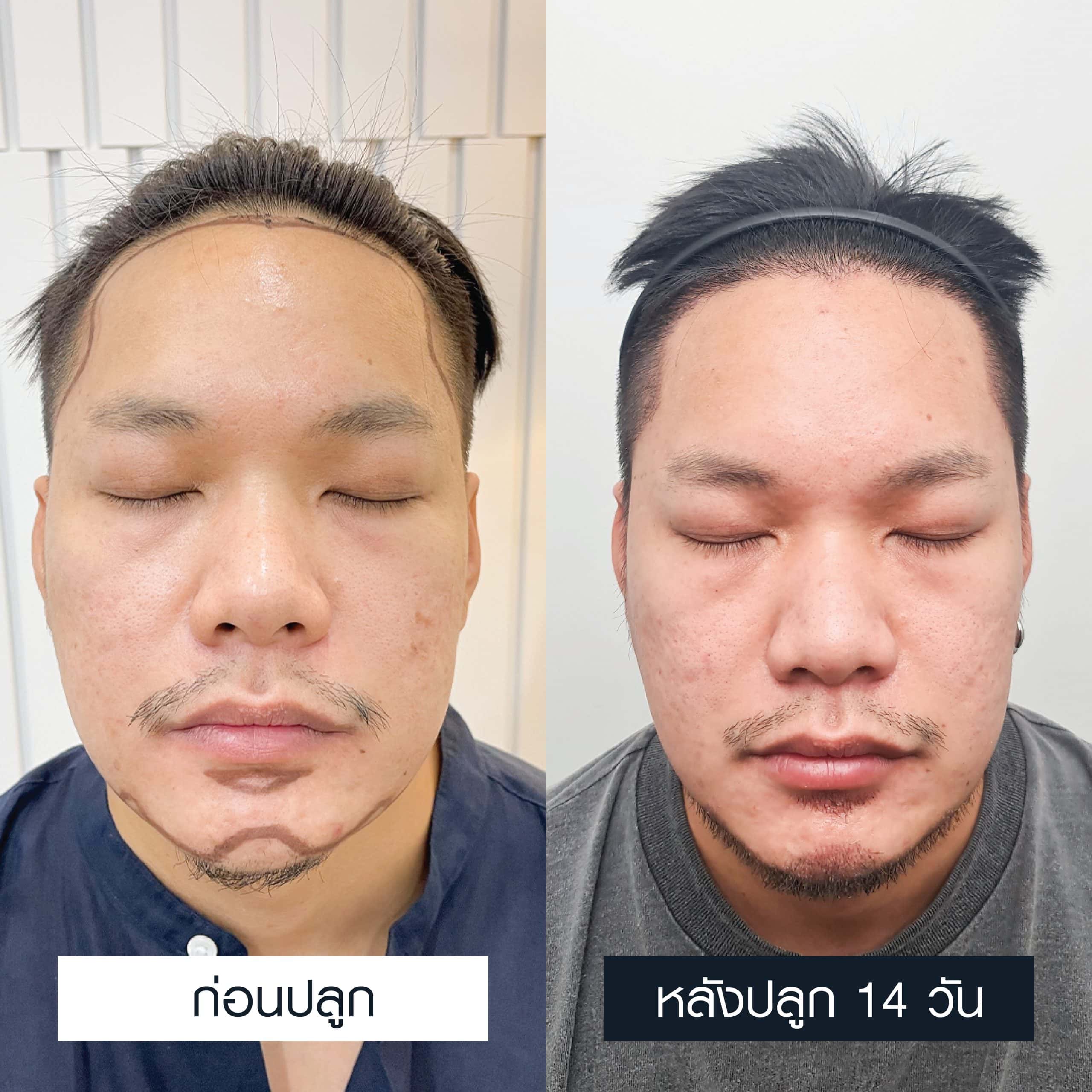 ภาพเปรียบเทียบก่อนและหลังปลูกหนวดเคราหลังผ่านไป 14 วัน