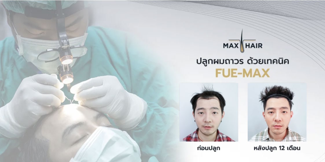 การปลูกผมด้วยเทคนิค FUE แก้ปัญหาผมบาง ผมร่วง หัวล้าน