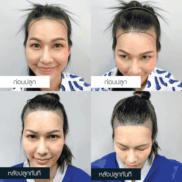 รีวิวการปลูกผมถาวรของดาราสาว แก้ม-กวินตา
